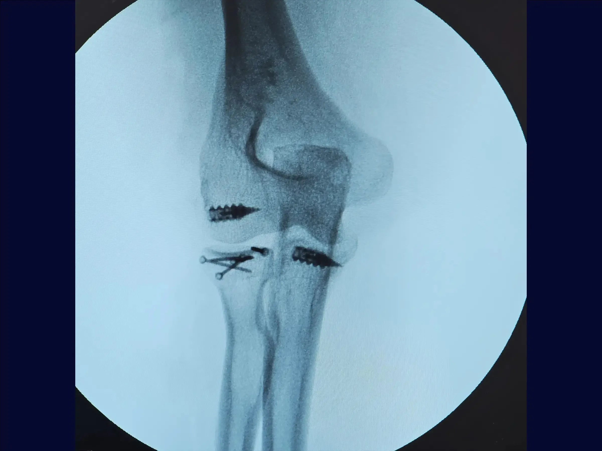 Multifragmentary Radial Head Fracture (Mason 3) with Associated Instability