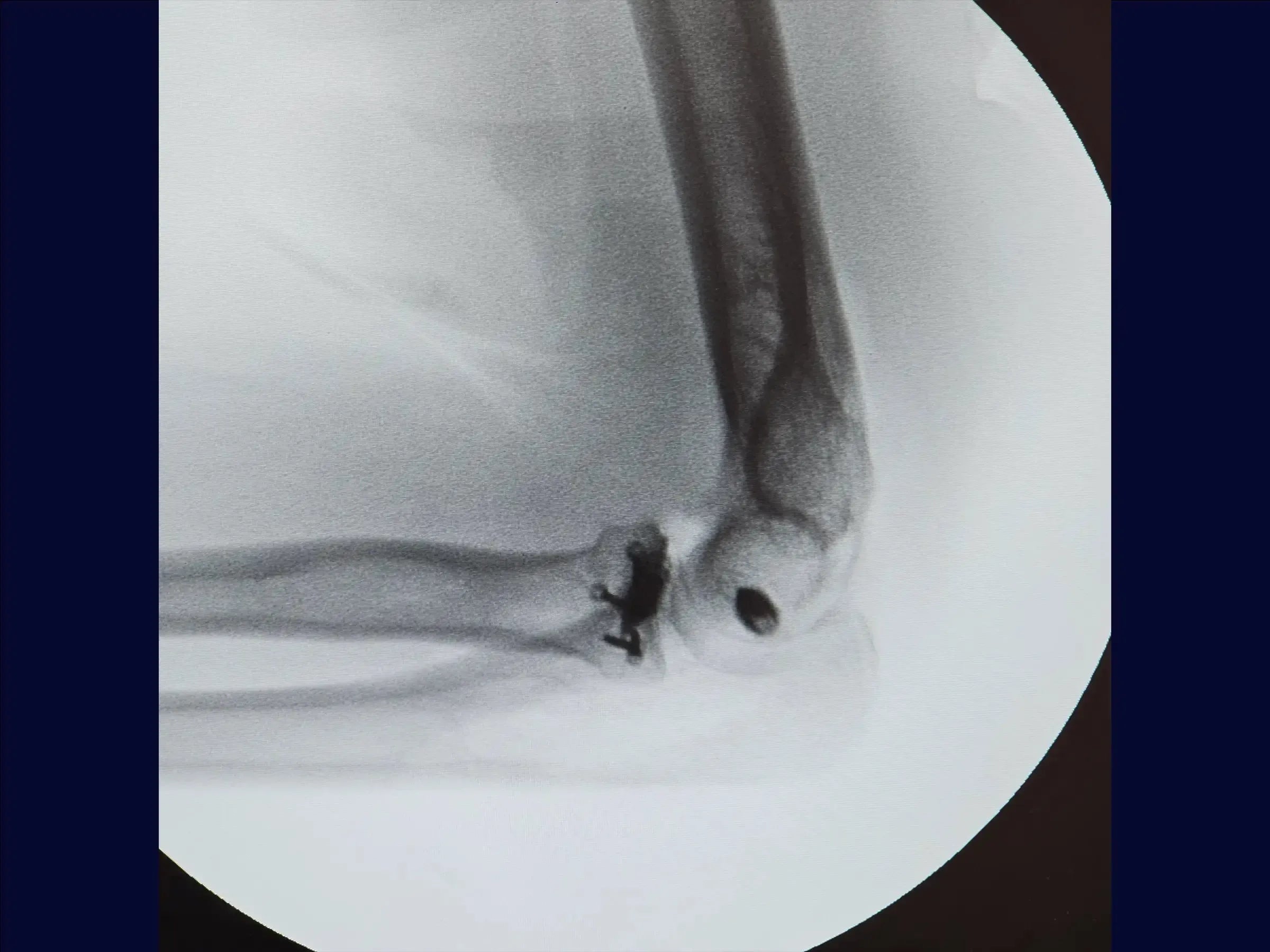 Multifragmentary Radial Head Fracture (Mason 3) with Associated Instability