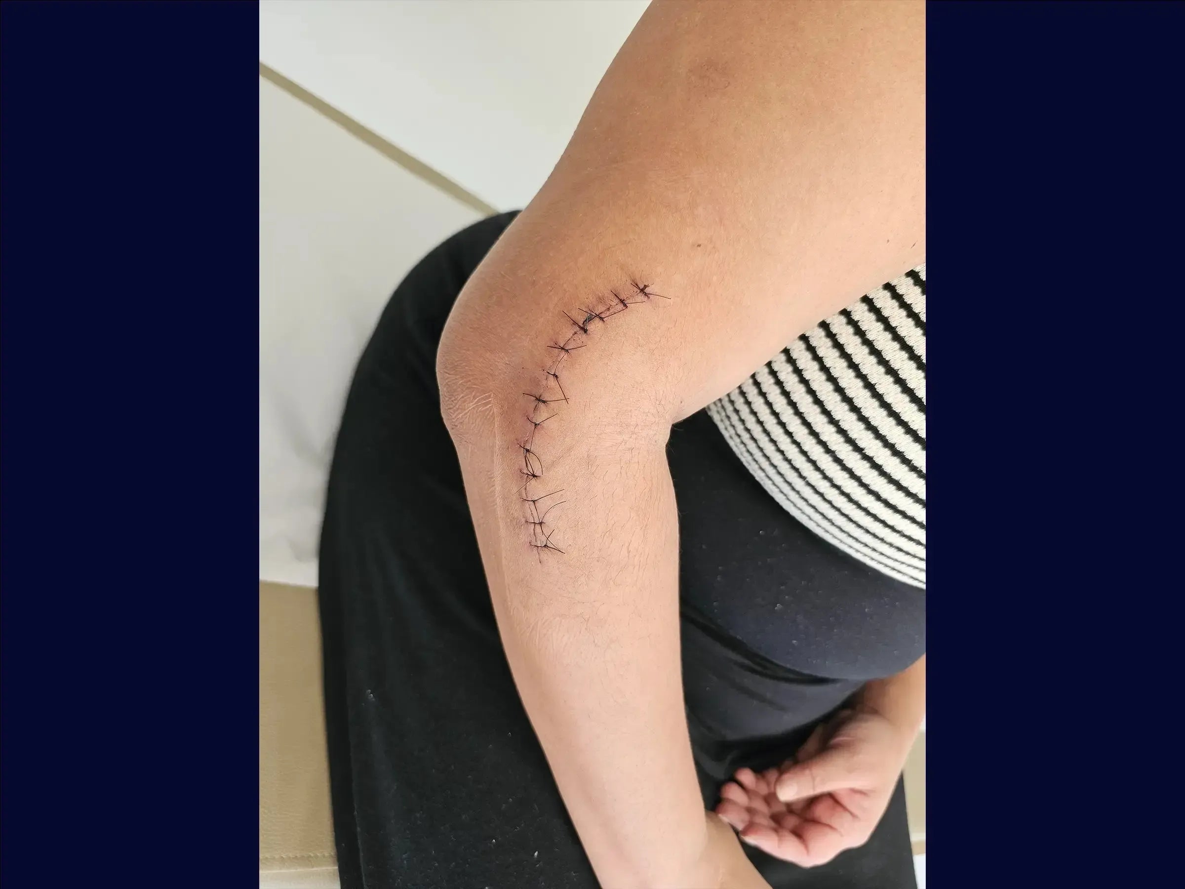 Multifragmentary Radial Head Fracture (Mason 3) with Associated Instability