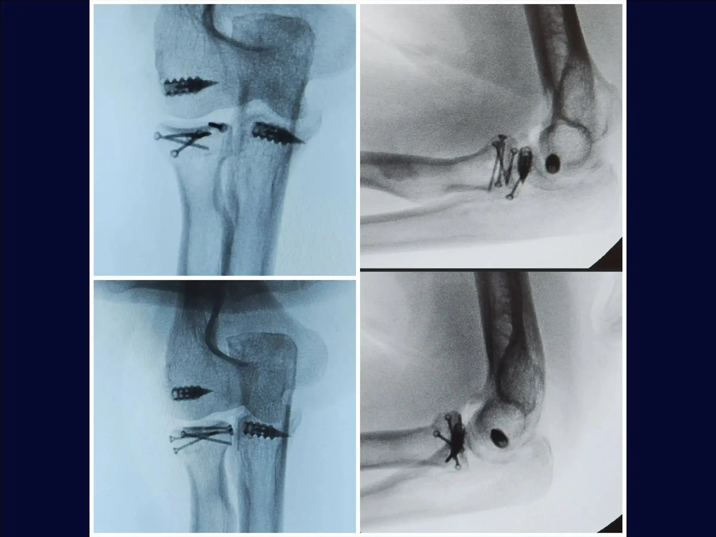 Multifragmentary Radial Head Fracture (Mason 3) with Associated Instability