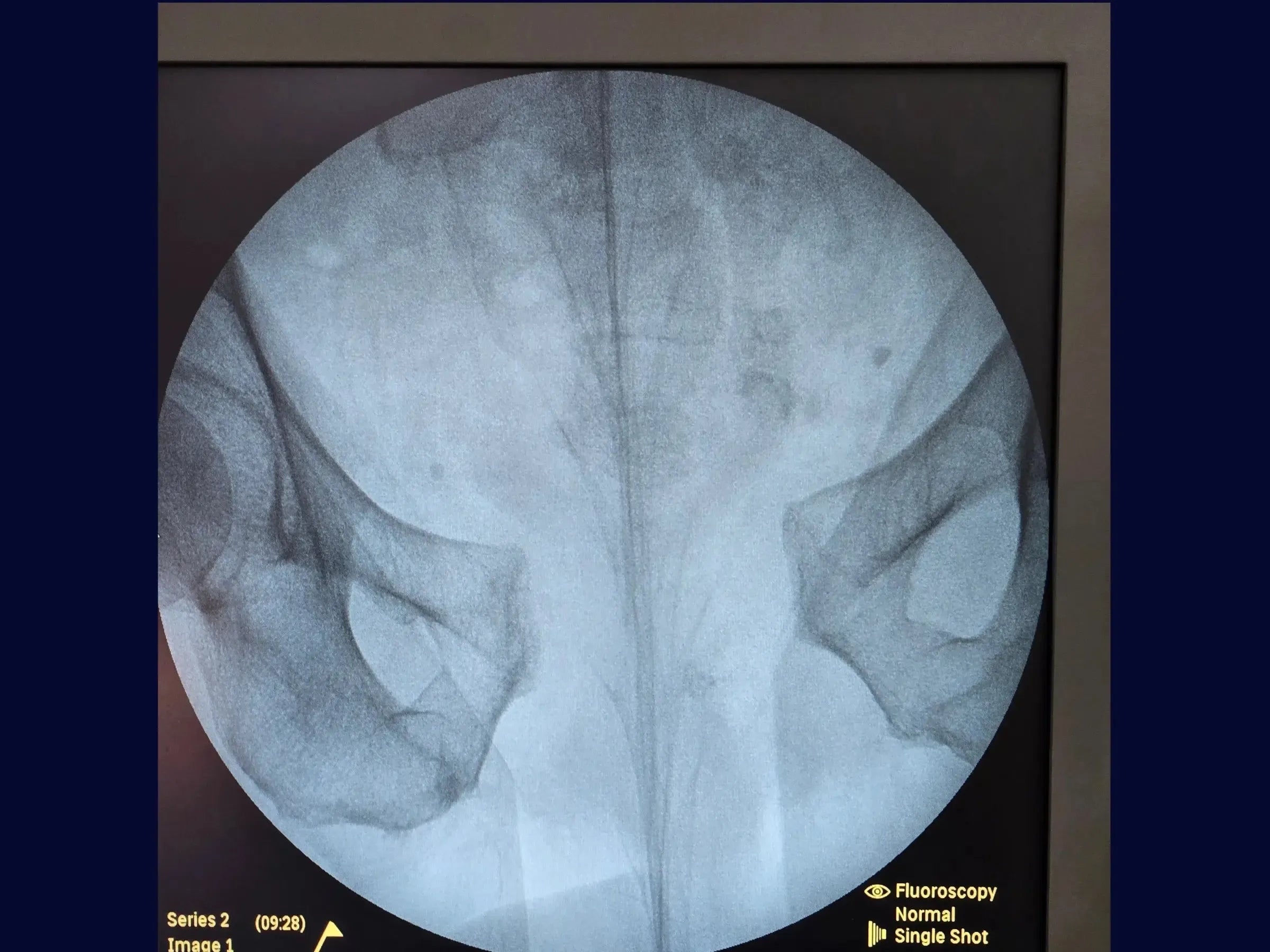 Open Book Pelvic Ring Injury (Pubic Symphysis Dislocation)