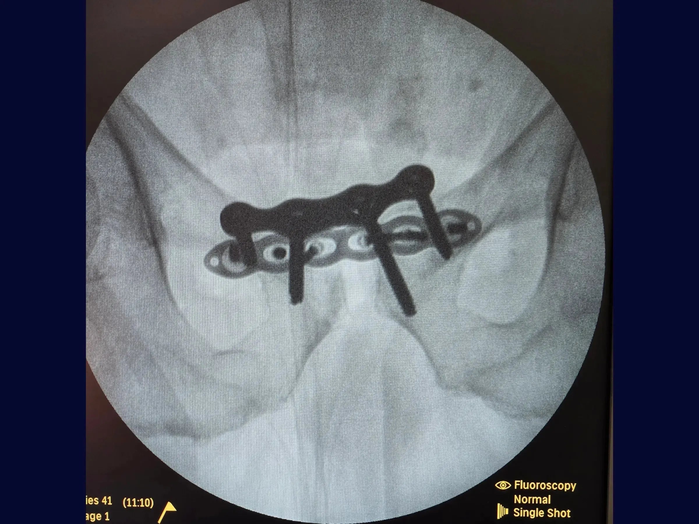 Open Book Pelvic Ring Injury (Pubic Symphysis Dislocation)