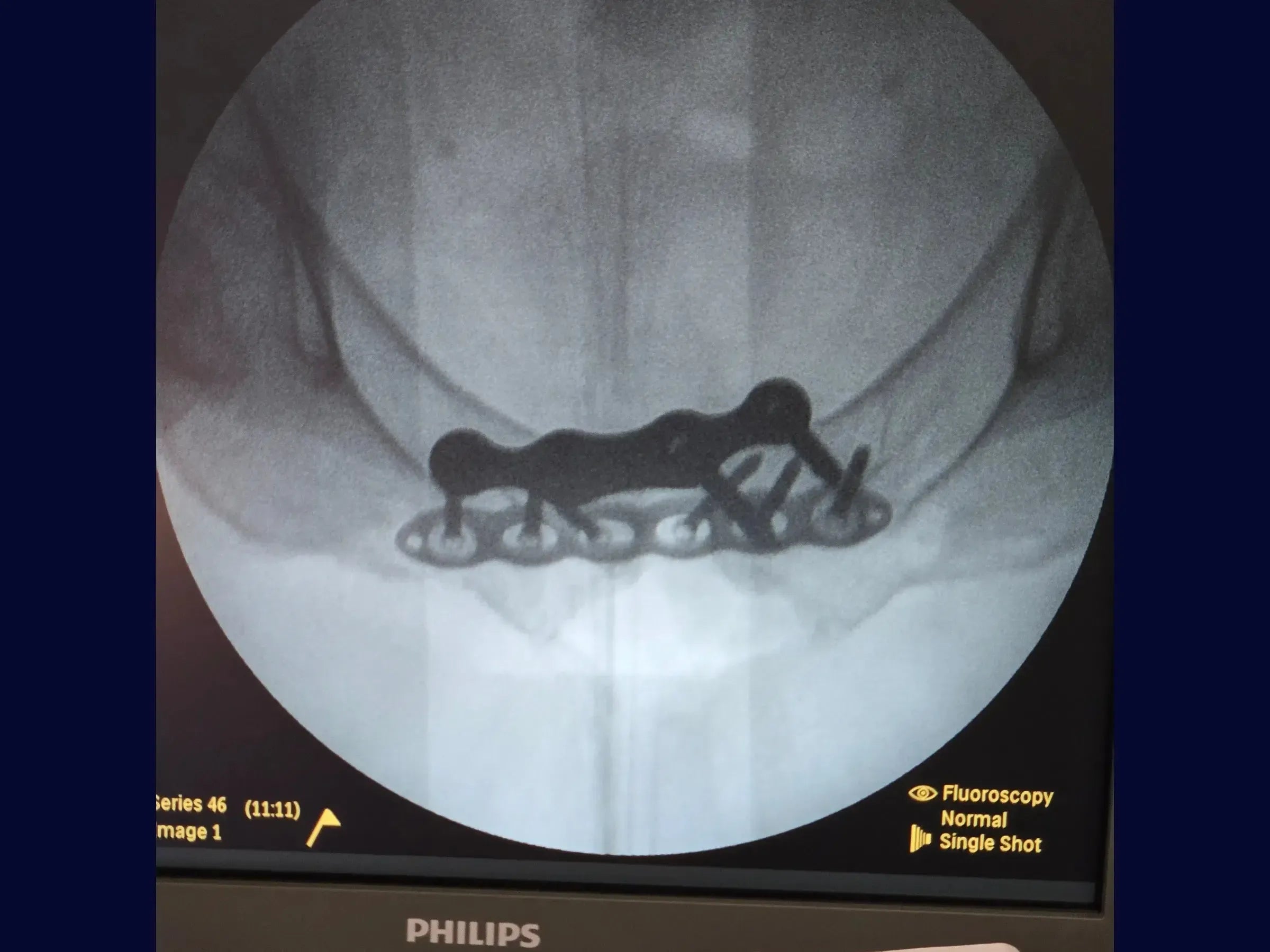 Open Book Pelvic Ring Injury (Pubic Symphysis Dislocation)