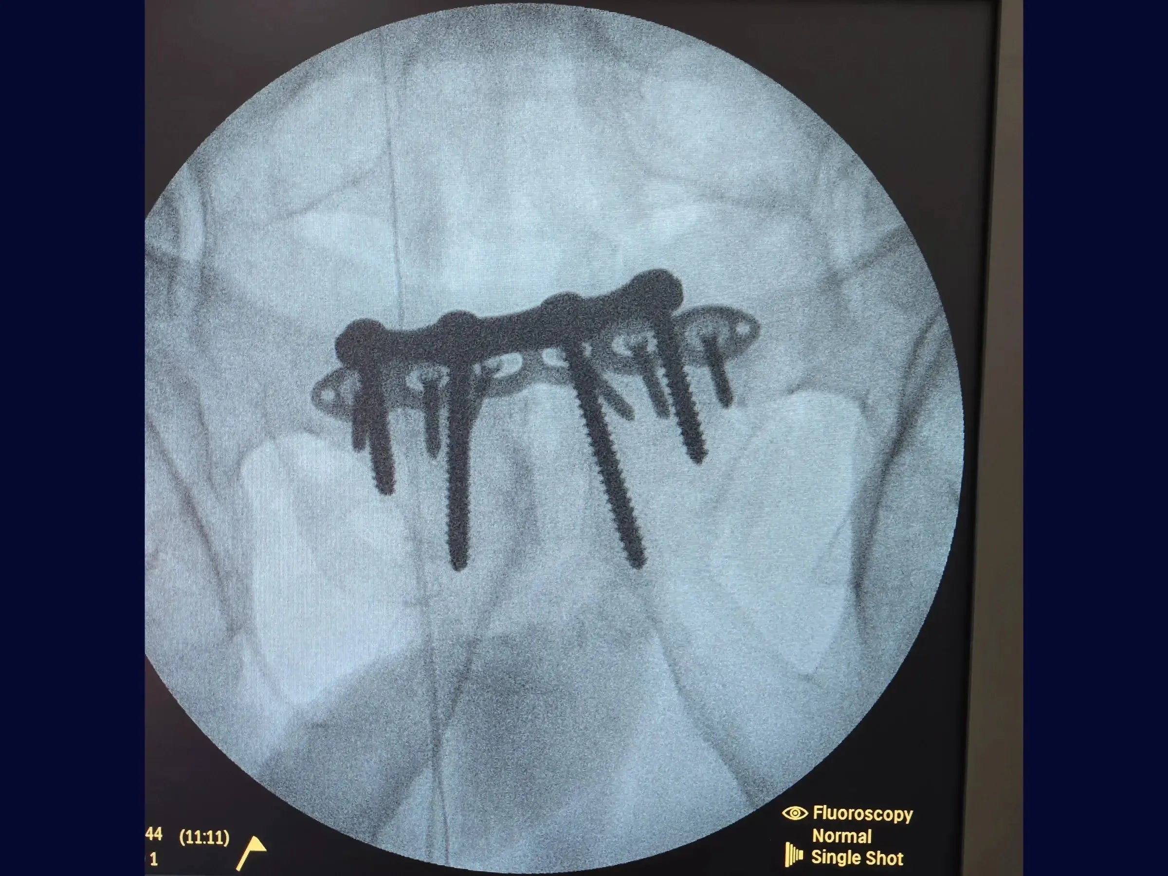 Open Book Pelvic Ring Injury (Pubic Symphysis Dislocation)