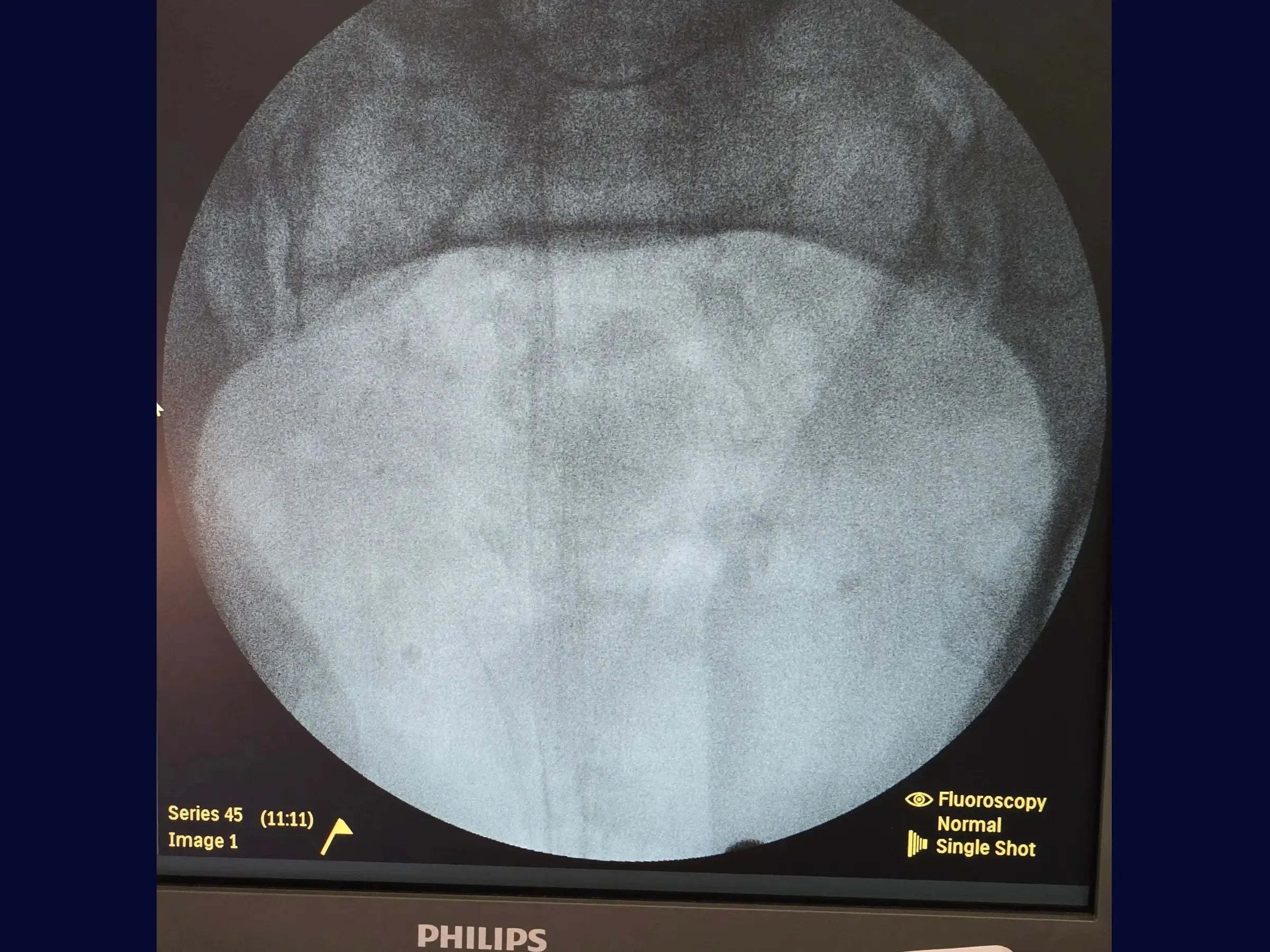 Open Book Pelvic Ring Injury (Pubic Symphysis Dislocation)