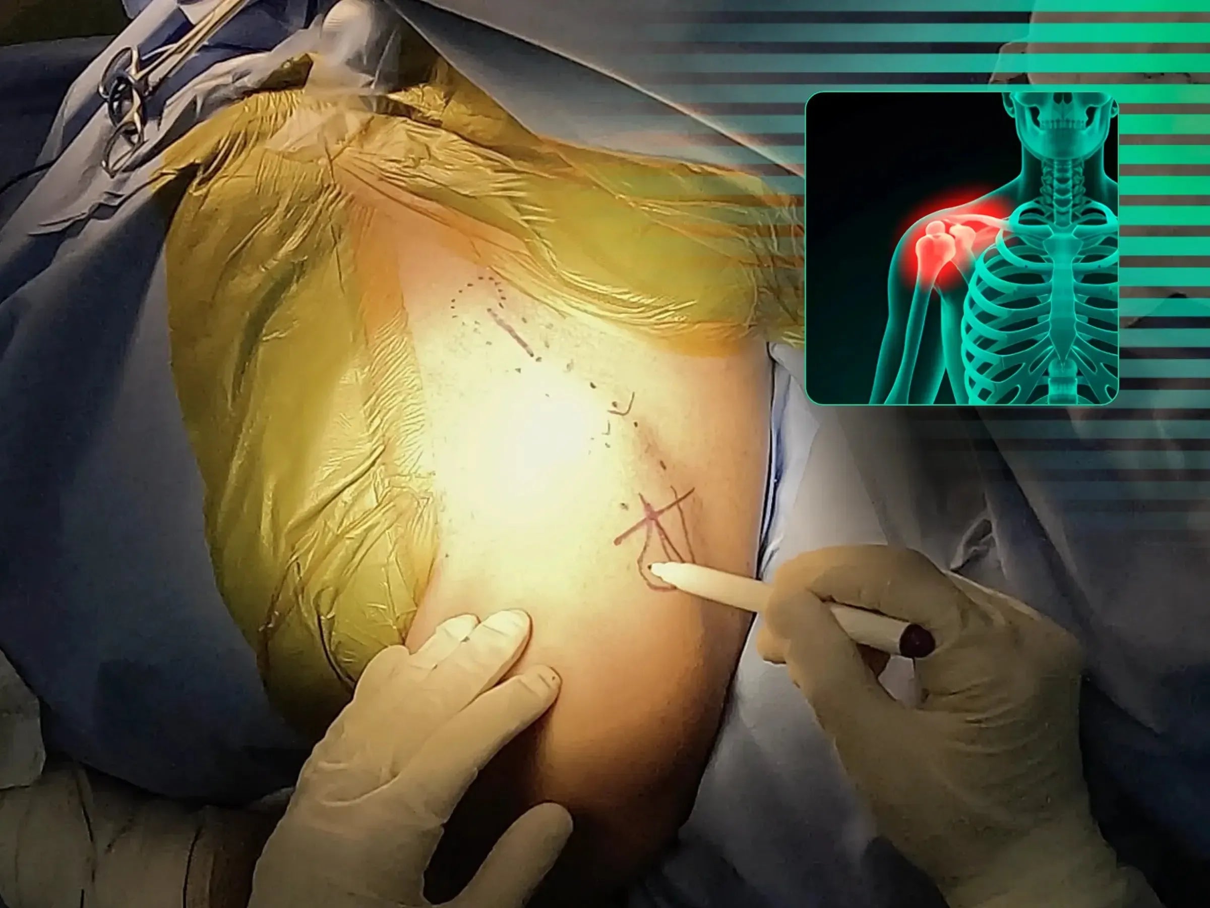 Minimally Invasive Osteosynthesis of Clavicle Fracture (Bridge Plating Technique)