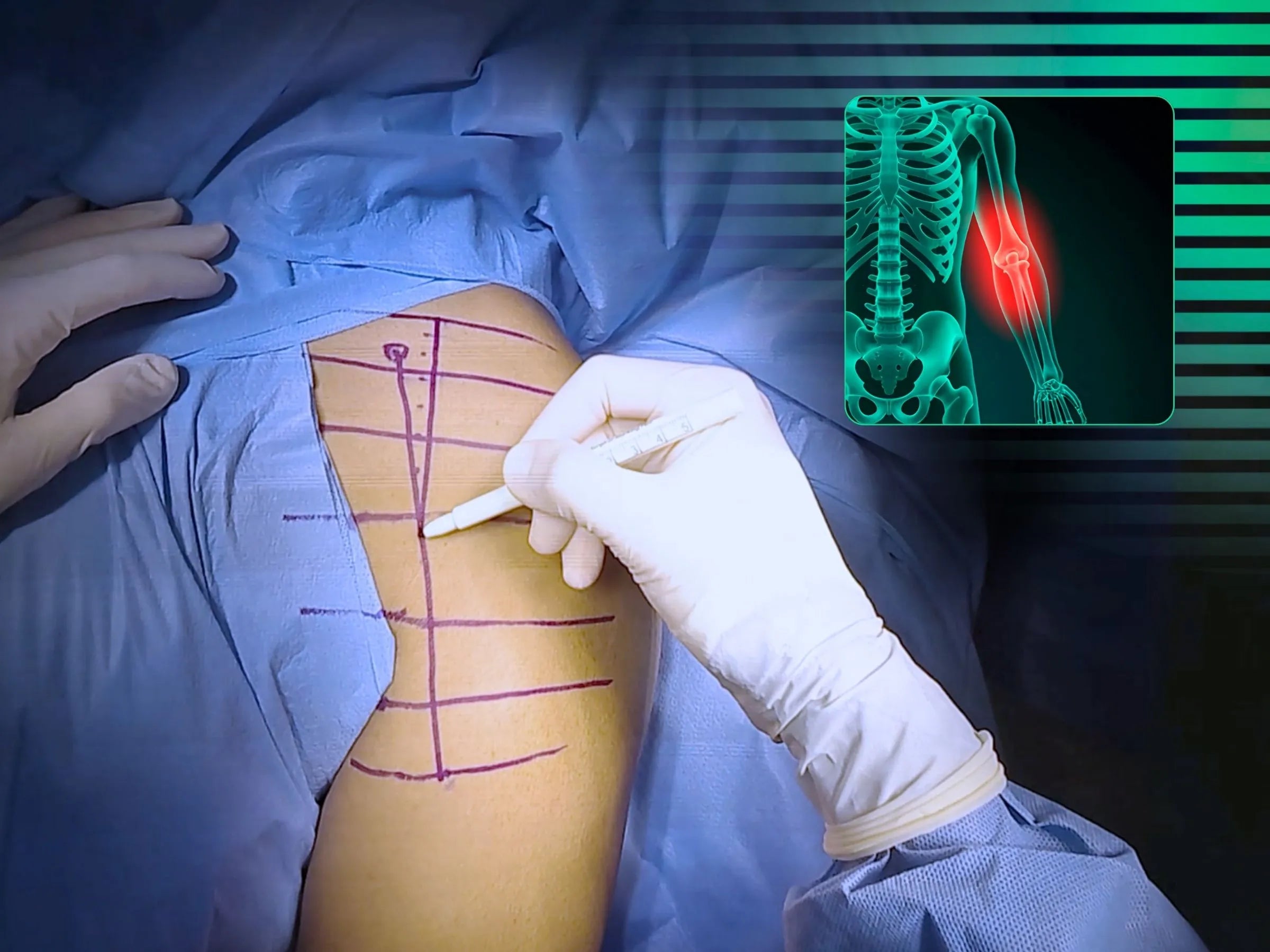 Osteossíntese do Úmero Proximal – Placa Medial