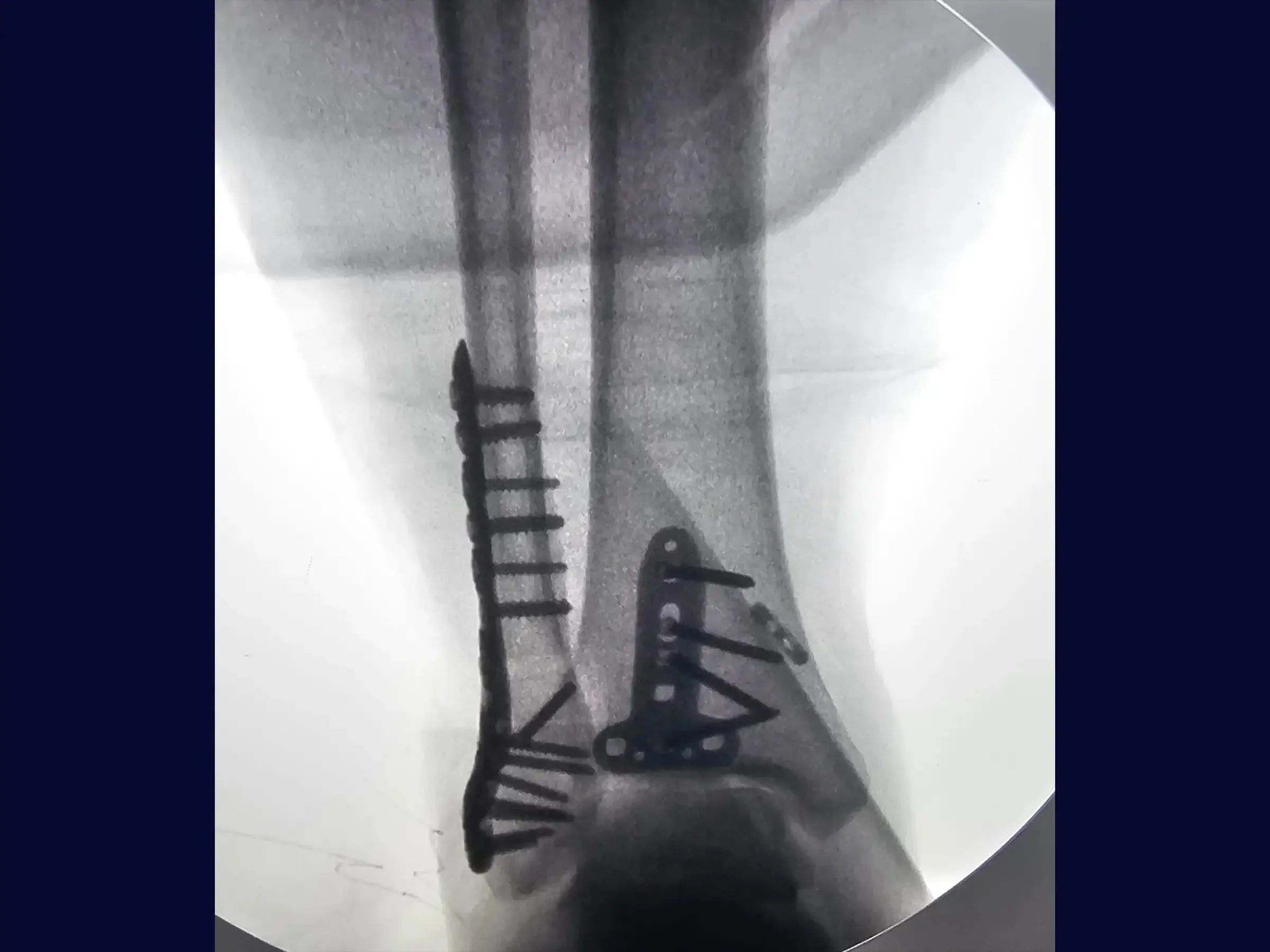Posterior Malleolus and Lateral Malleolus Fracture (Single Posterolateral Approach)