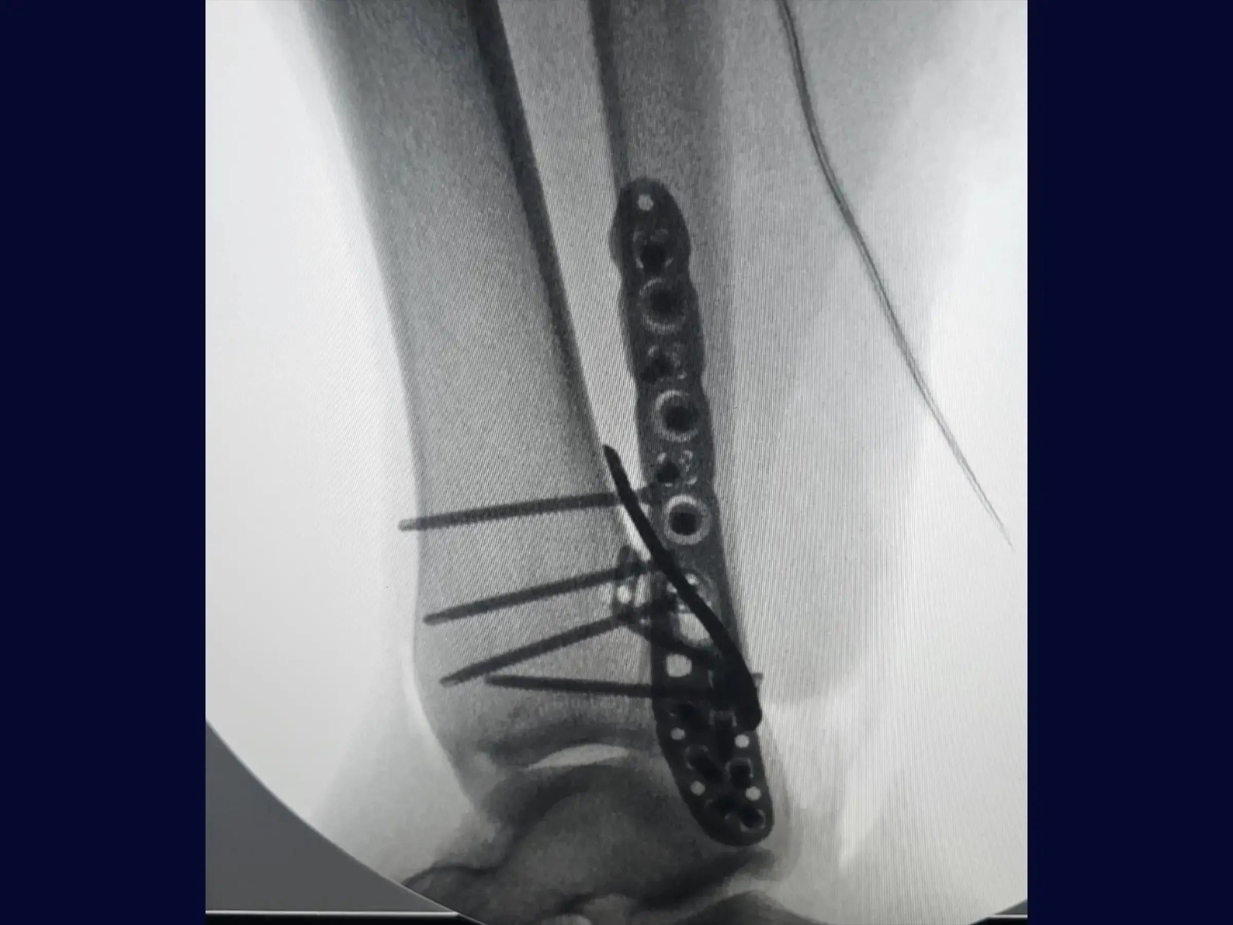Posterior Malleolus and Lateral Malleolus Fracture (Single Posterolateral Approach)
