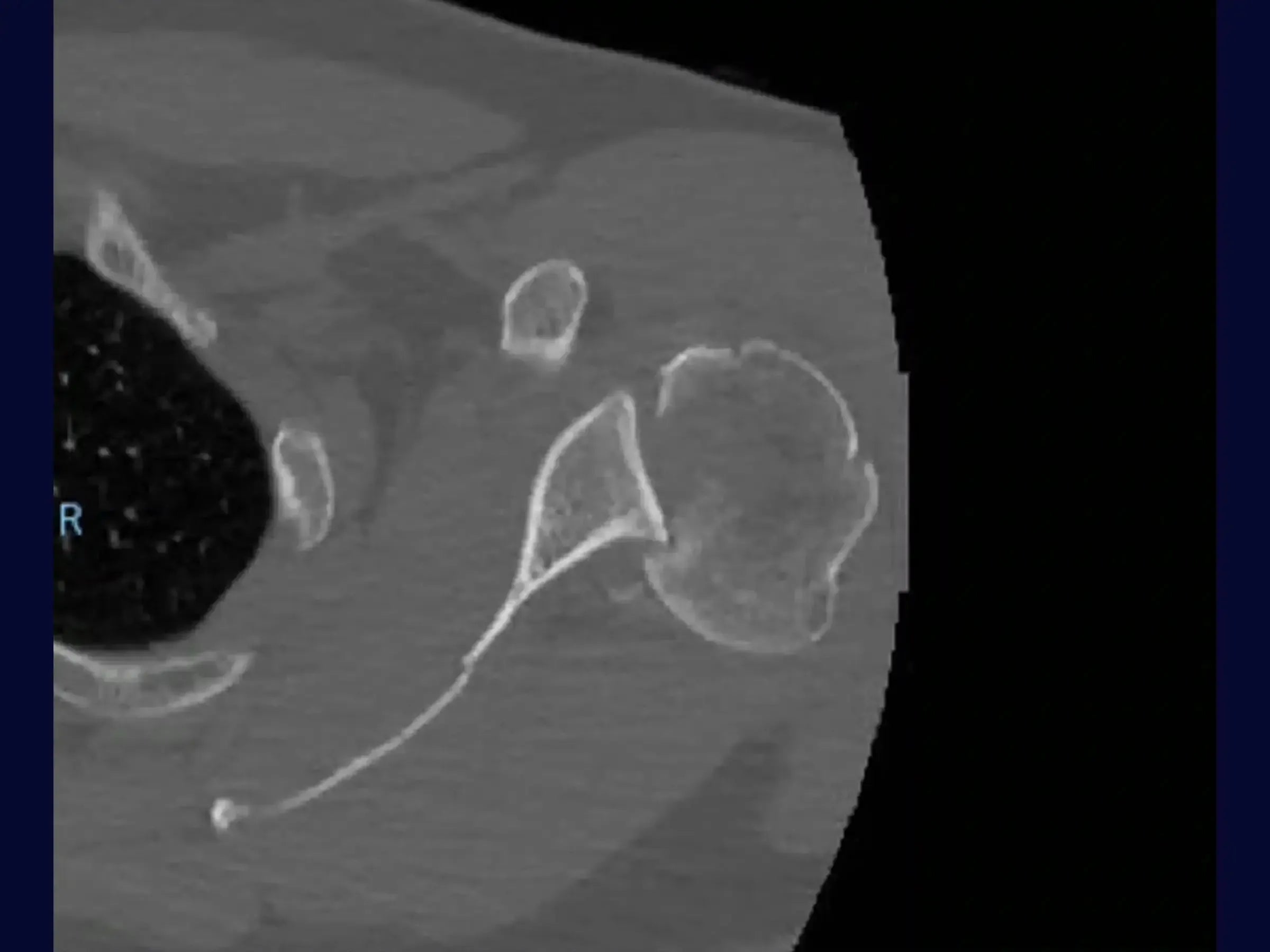 Posterior Shoulder Dislocation with Humeral Head Impaction