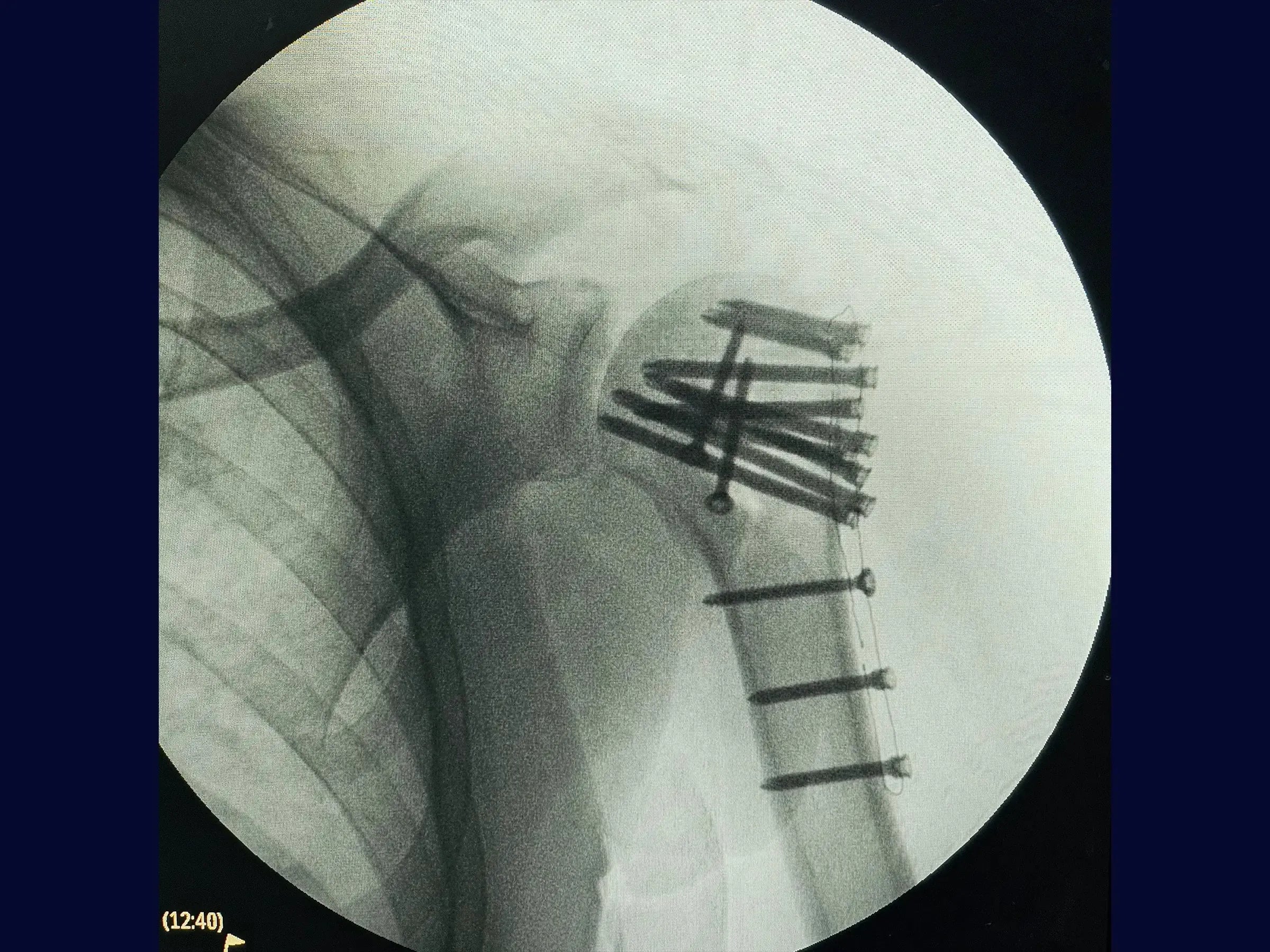 Posterior Shoulder Dislocation with Humeral Head Impaction