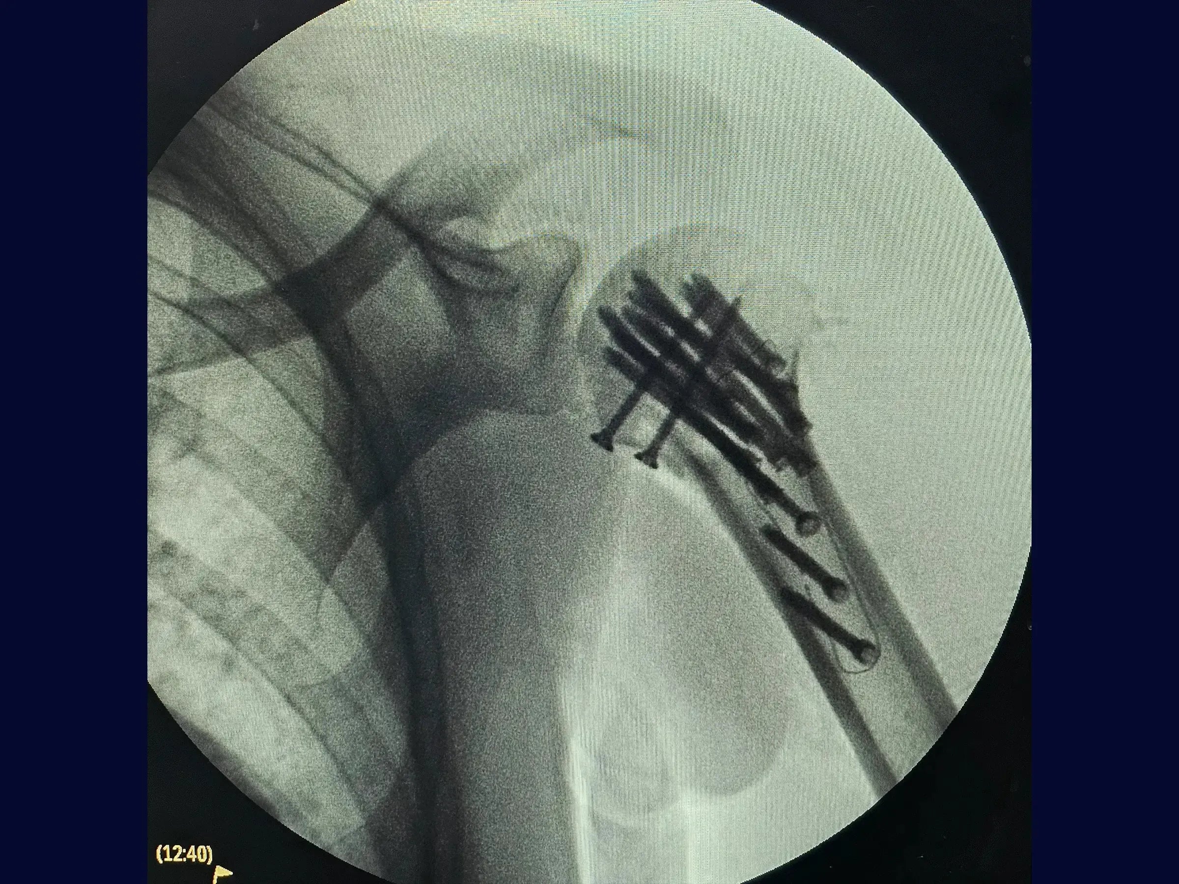 Posterior Shoulder Dislocation with Humeral Head Impaction