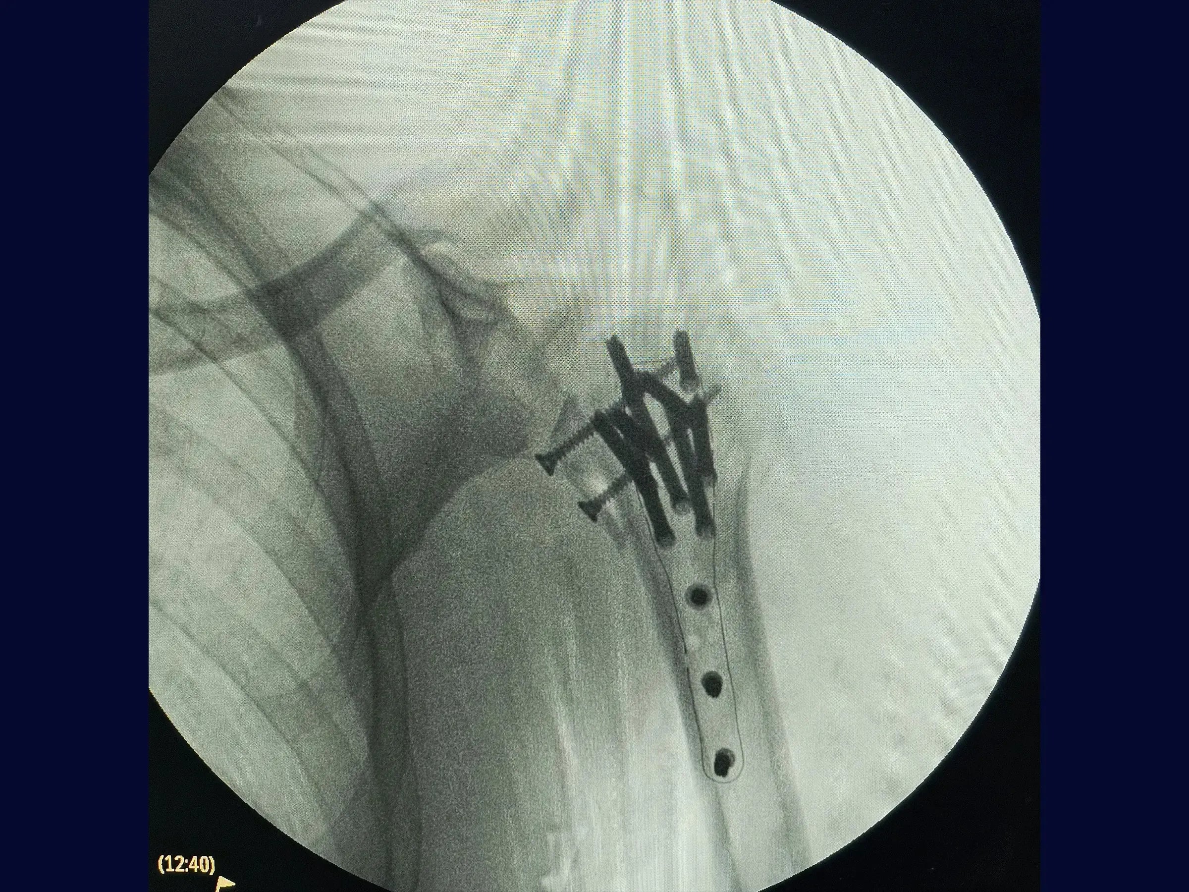 Posterior Shoulder Dislocation with Humeral Head Impaction