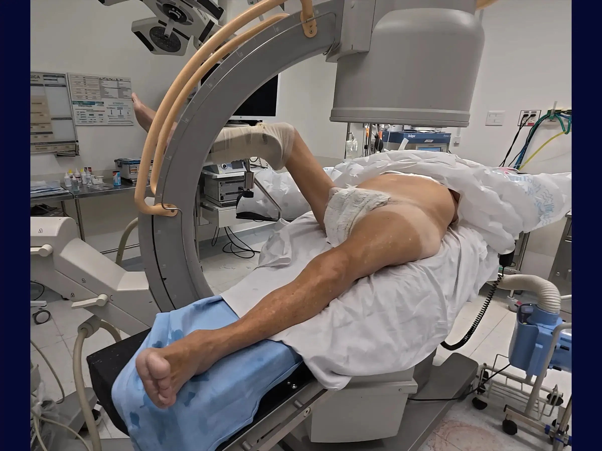 Proximal Femur Fractures Without a Traction Table