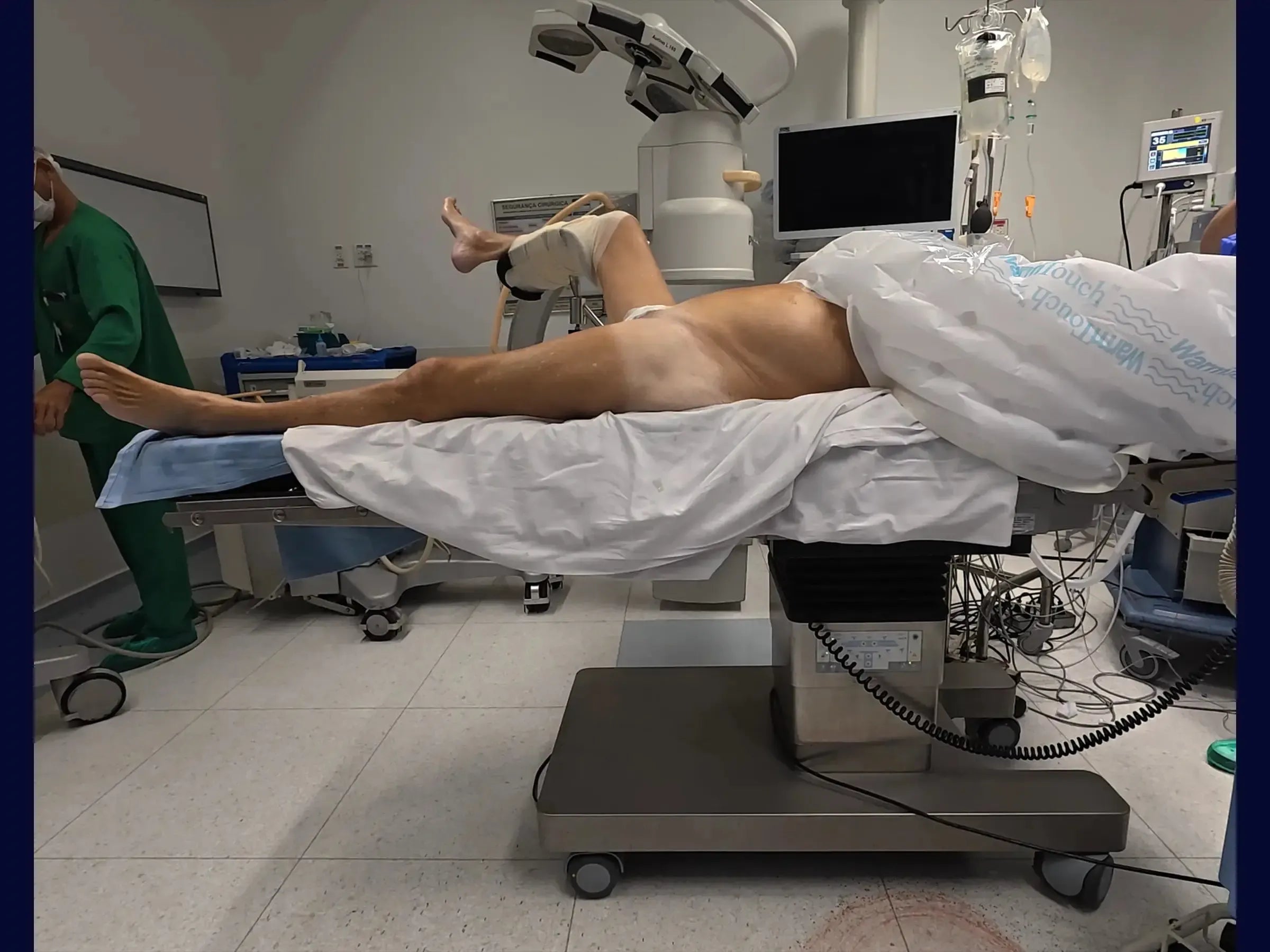 Proximal Femur Fractures Without a Traction Table