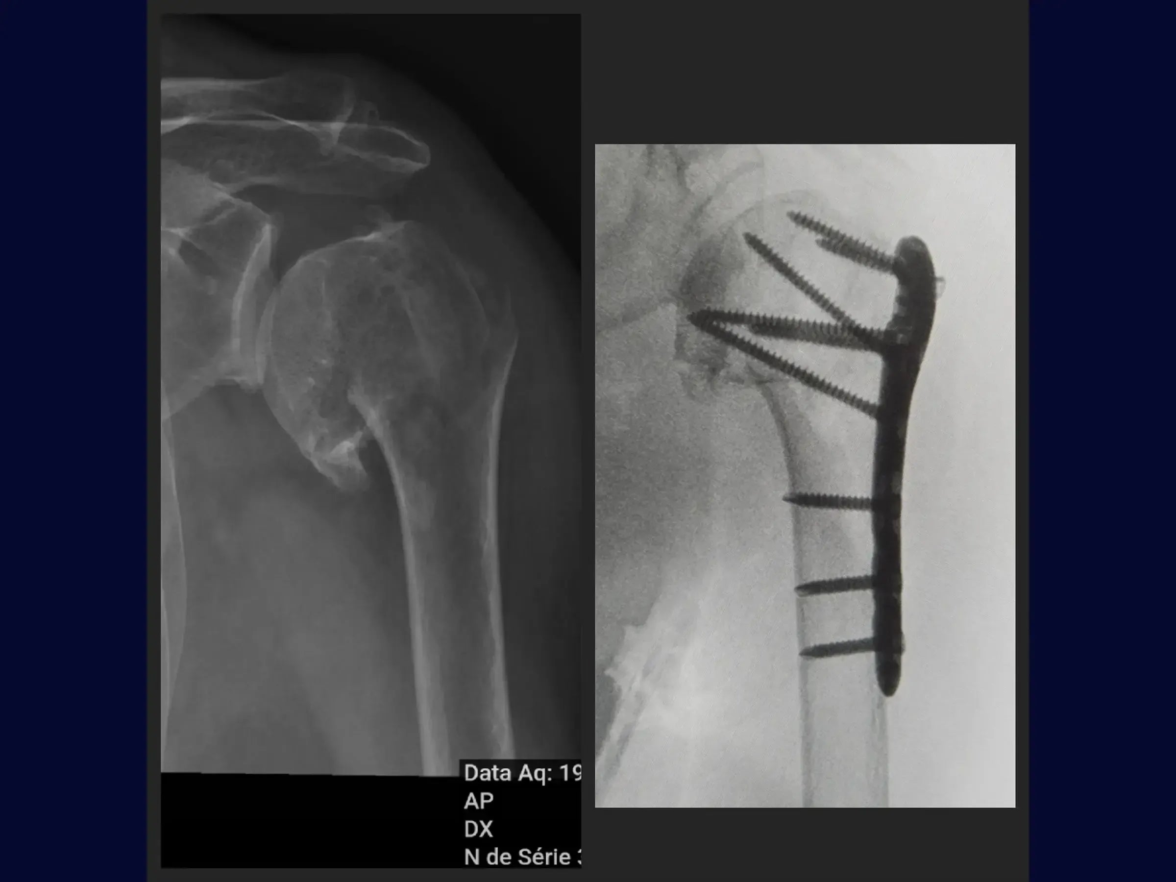 Proximal Humerus Fracture with Plate (Deltopectoral Approach)