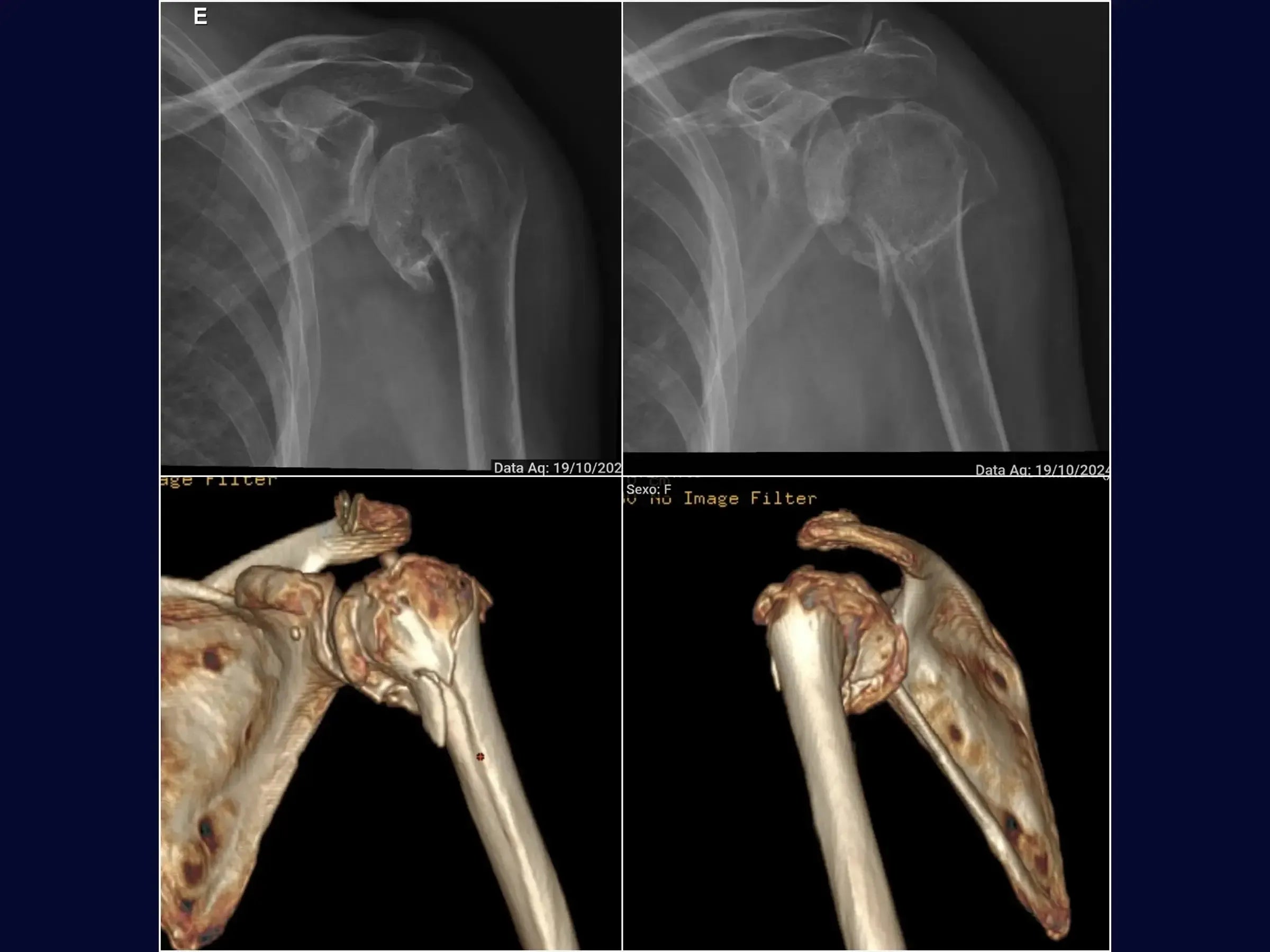 Proximal Humerus Fracture with Plate (Deltopectoral Approach)