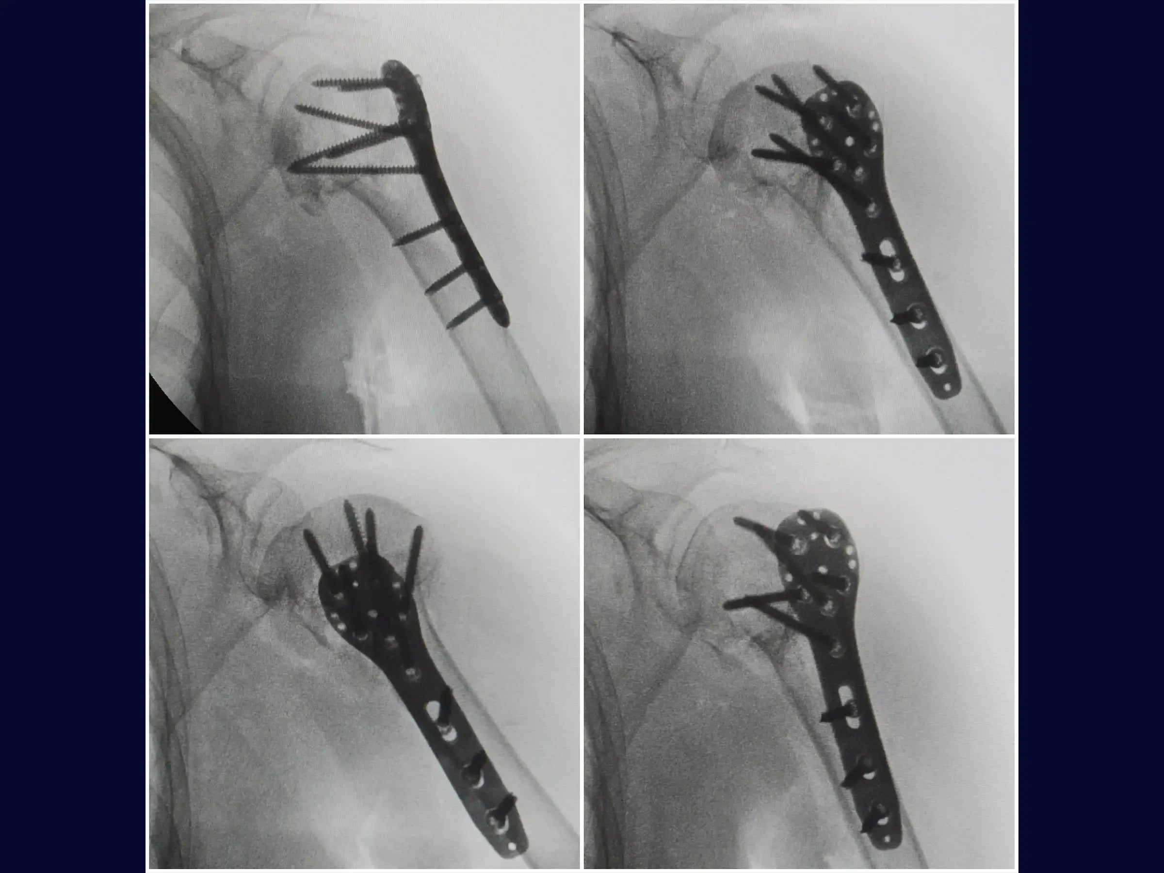 Proximal Humerus Fracture with Plate (Deltopectoral Approach)