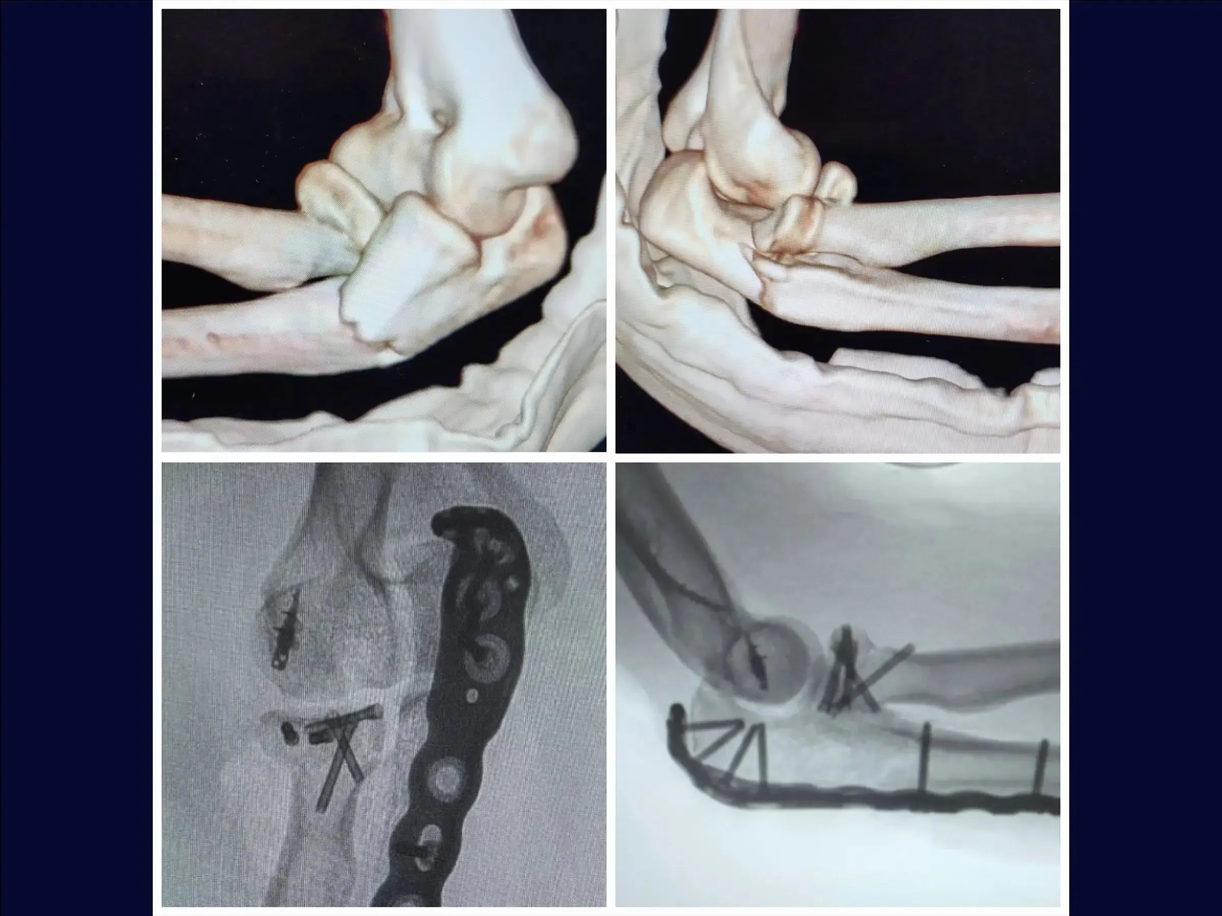 Proximal Ulna Metaphyseal Fracture with Dislocation and Radial Head Fracture (Monteggia Variant)
