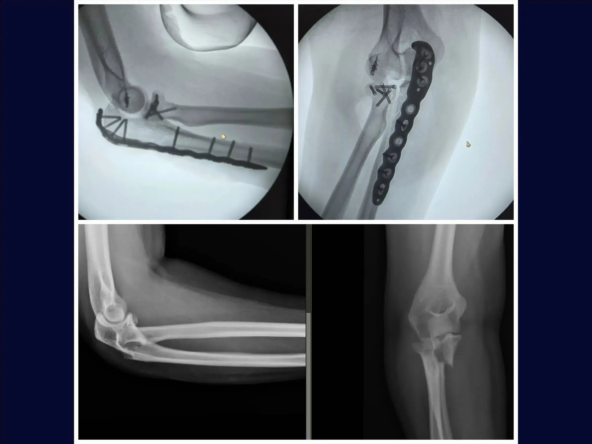 Proximal Ulna Metaphyseal Fracture with Dislocation and Radial Head Fracture (Monteggia Variant)