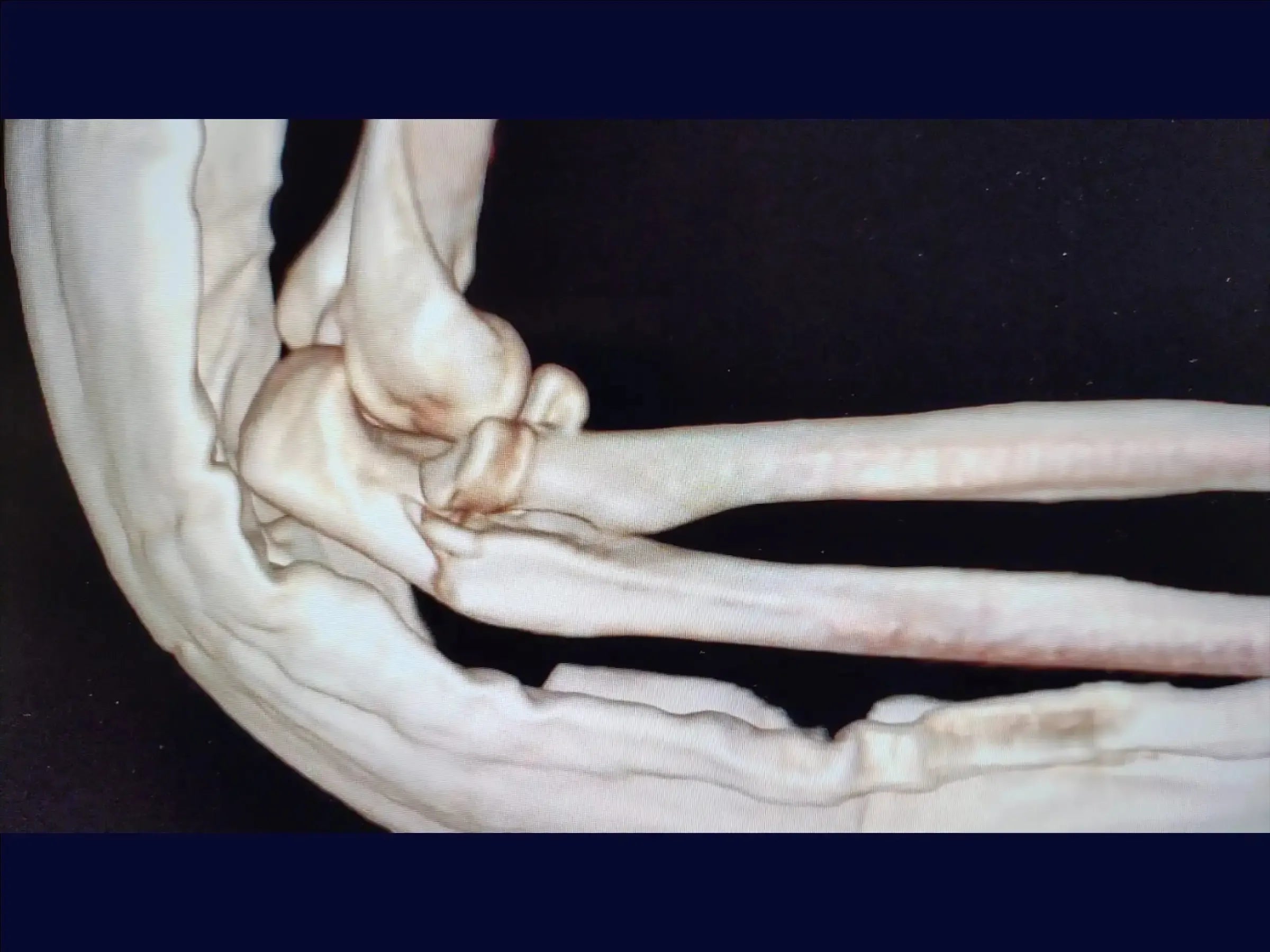 Proximal Ulna Metaphyseal Fracture with Dislocation and Radial Head Fracture (Monteggia Variant)