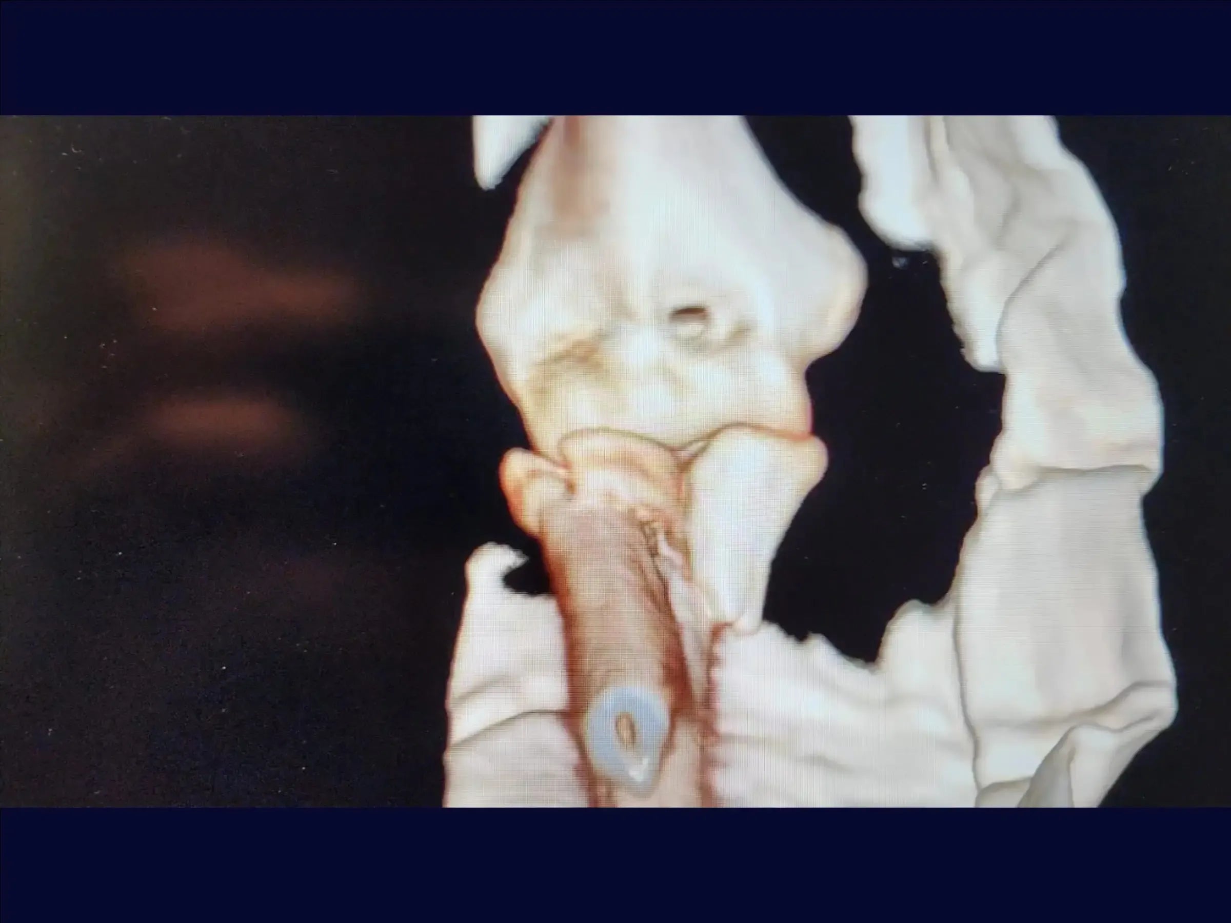 Proximal Ulna Metaphyseal Fracture with Dislocation and Radial Head Fracture (Monteggia Variant)