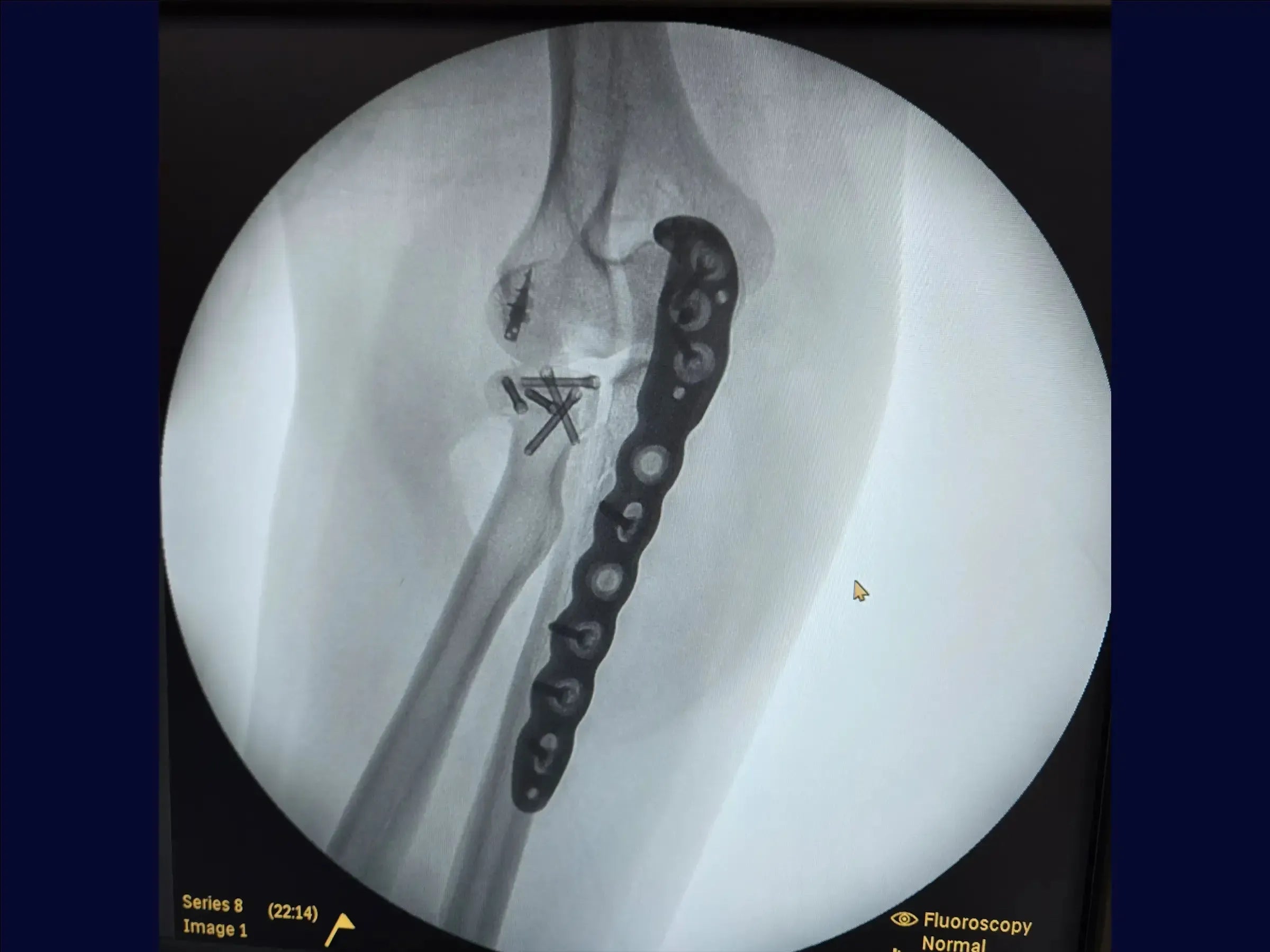 Proximal Ulna Metaphyseal Fracture with Dislocation and Radial Head Fracture (Monteggia Variant)