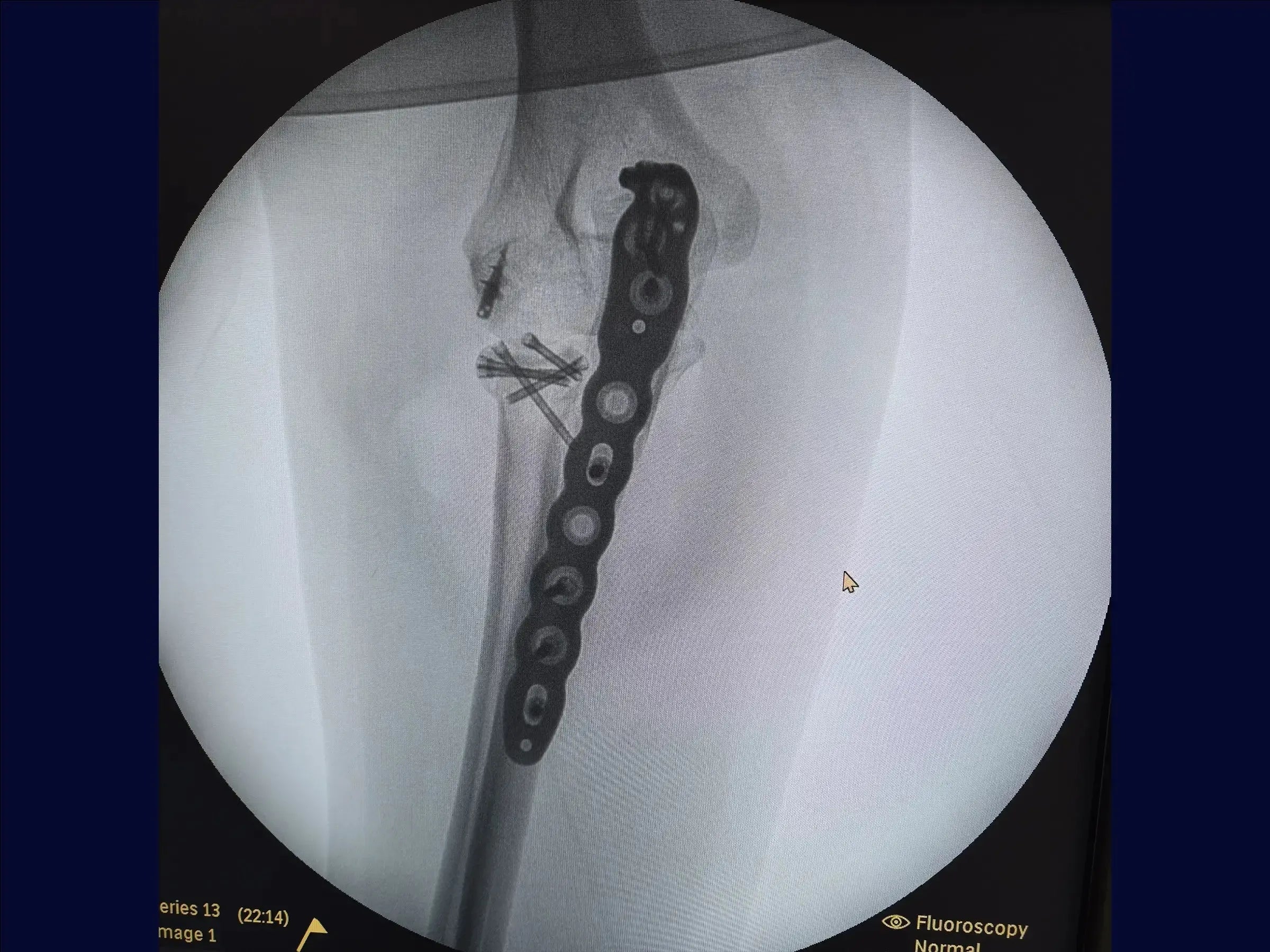 Proximal Ulna Metaphyseal Fracture with Dislocation and Radial Head Fracture (Monteggia Variant)