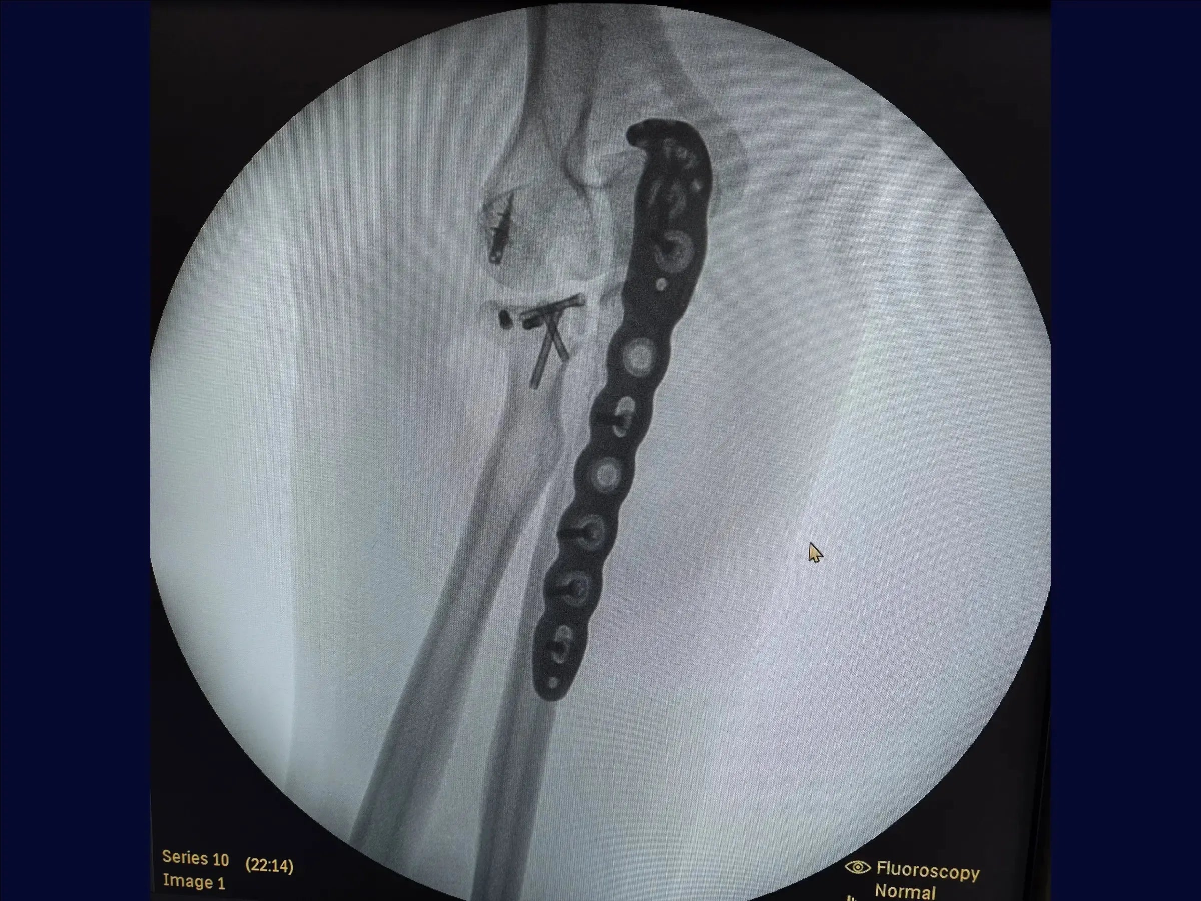 Proximal Ulna Metaphyseal Fracture with Dislocation and Radial Head Fracture (Monteggia Variant)
