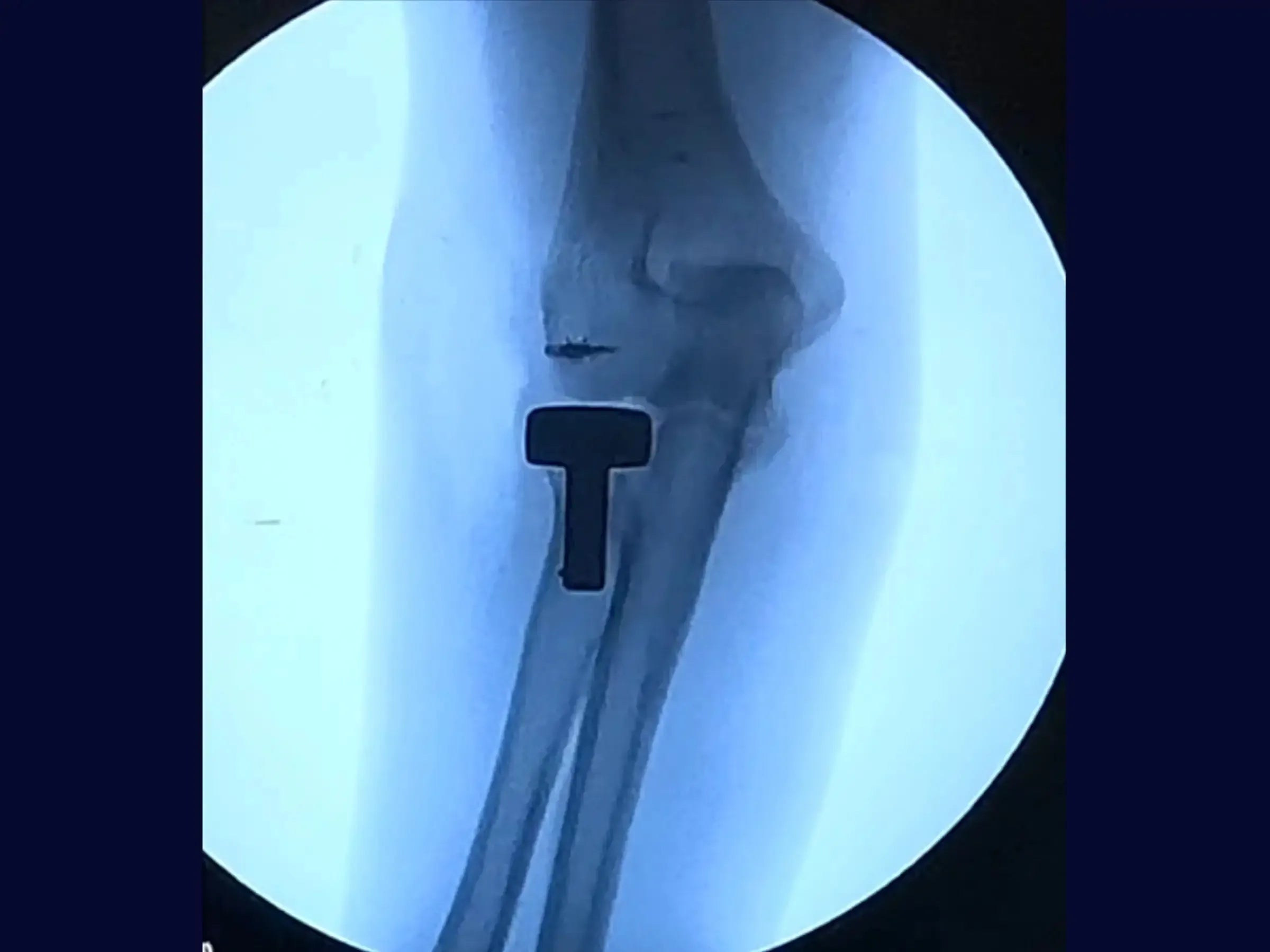 Radial Head Arthroplasty for Multifragmentary Fracture