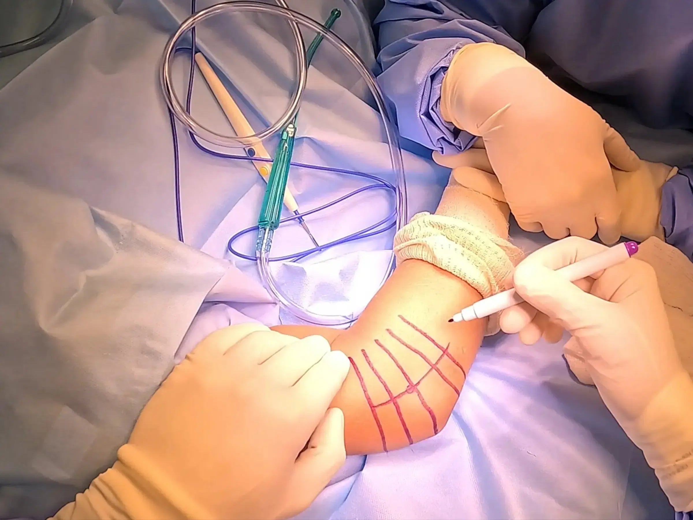 Radial Head Arthroplasty for Multifragmentary Fracture