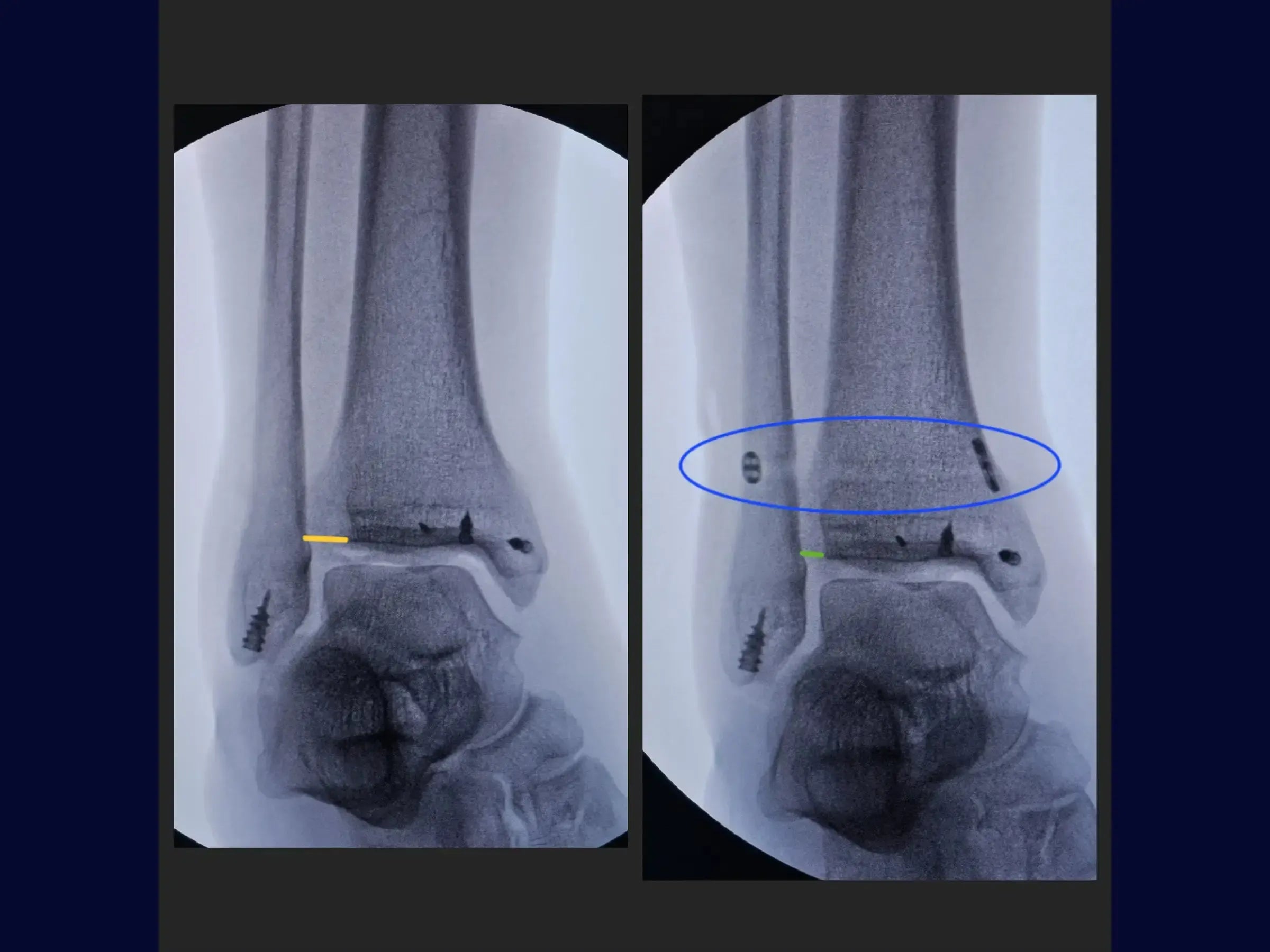 Reconstrução 360 Graus para Lesões Complexas do Tornozelo (Tendão de Aquiles, Tibial Posterior e Lesões Ligamentares)