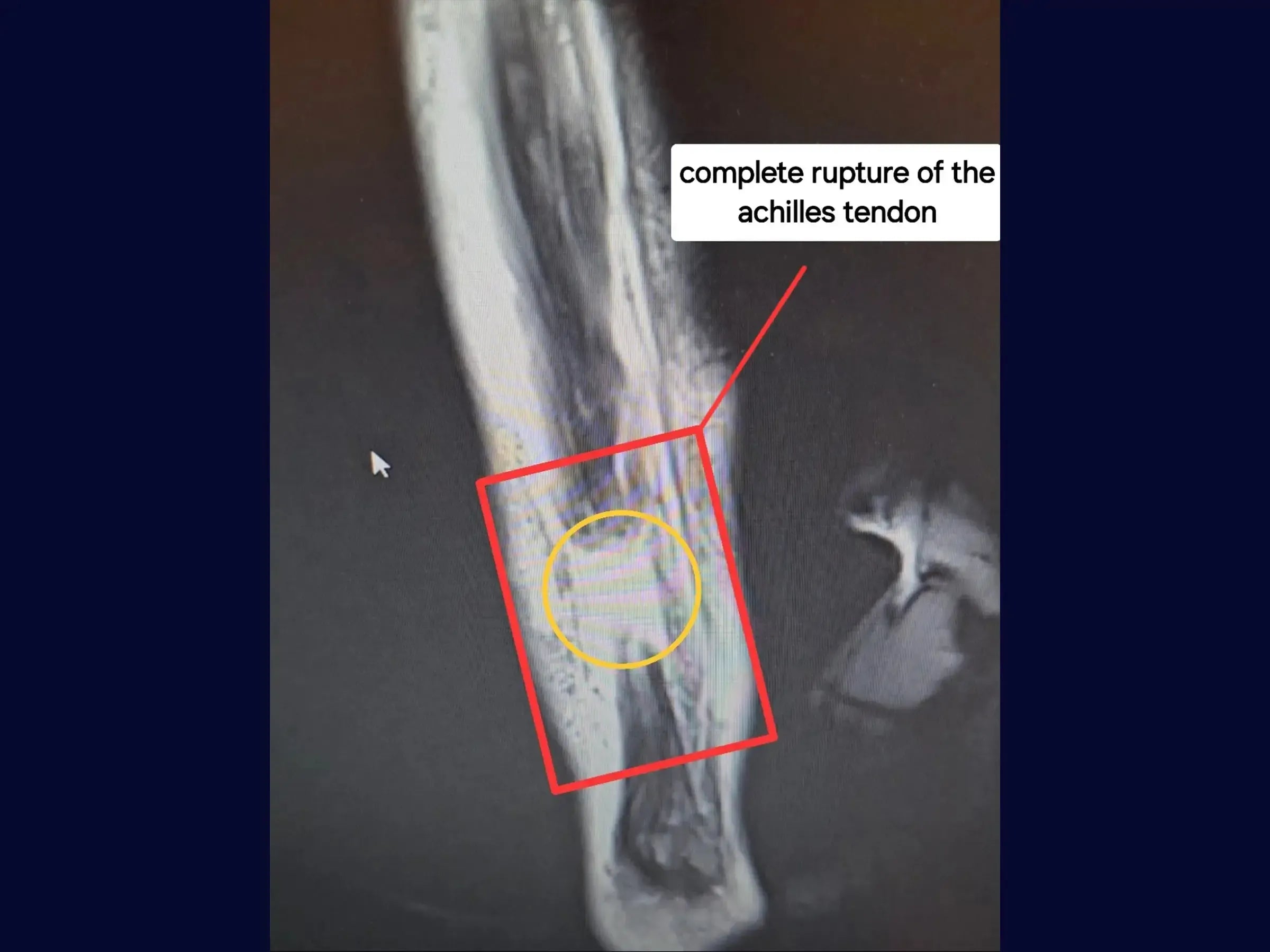 Reconstrução 360 Graus para Lesões Complexas do Tornozelo (Tendão de Aquiles, Tibial Posterior e Lesões Ligamentares)