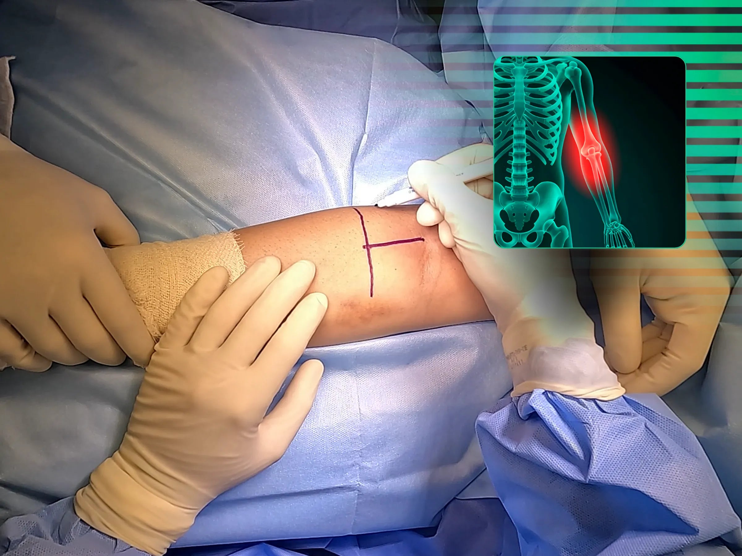 Reconstrução Anatômica do Tendão Distal do Bíceps - 01 (TightRope)