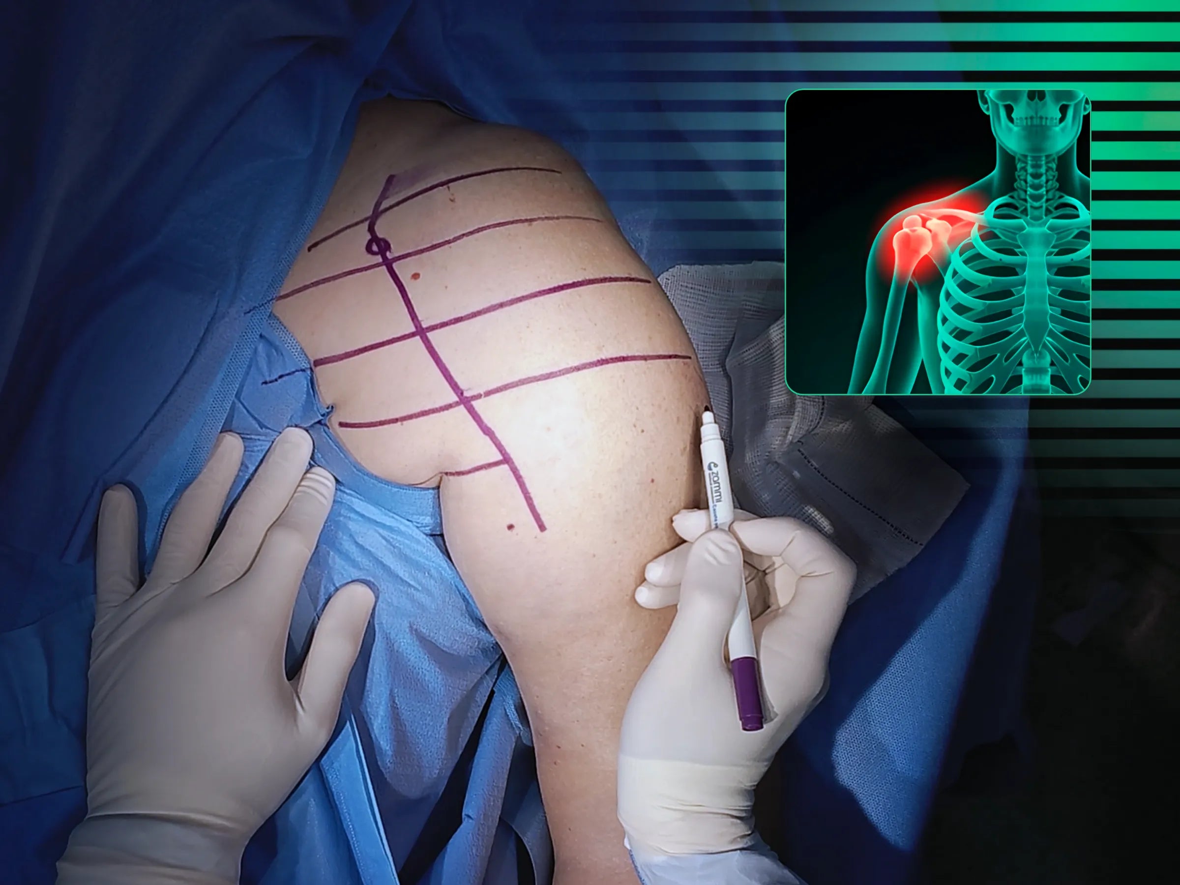 Reconstrução de Fratura Complexa em Quatro Partes do Úmero Proximal