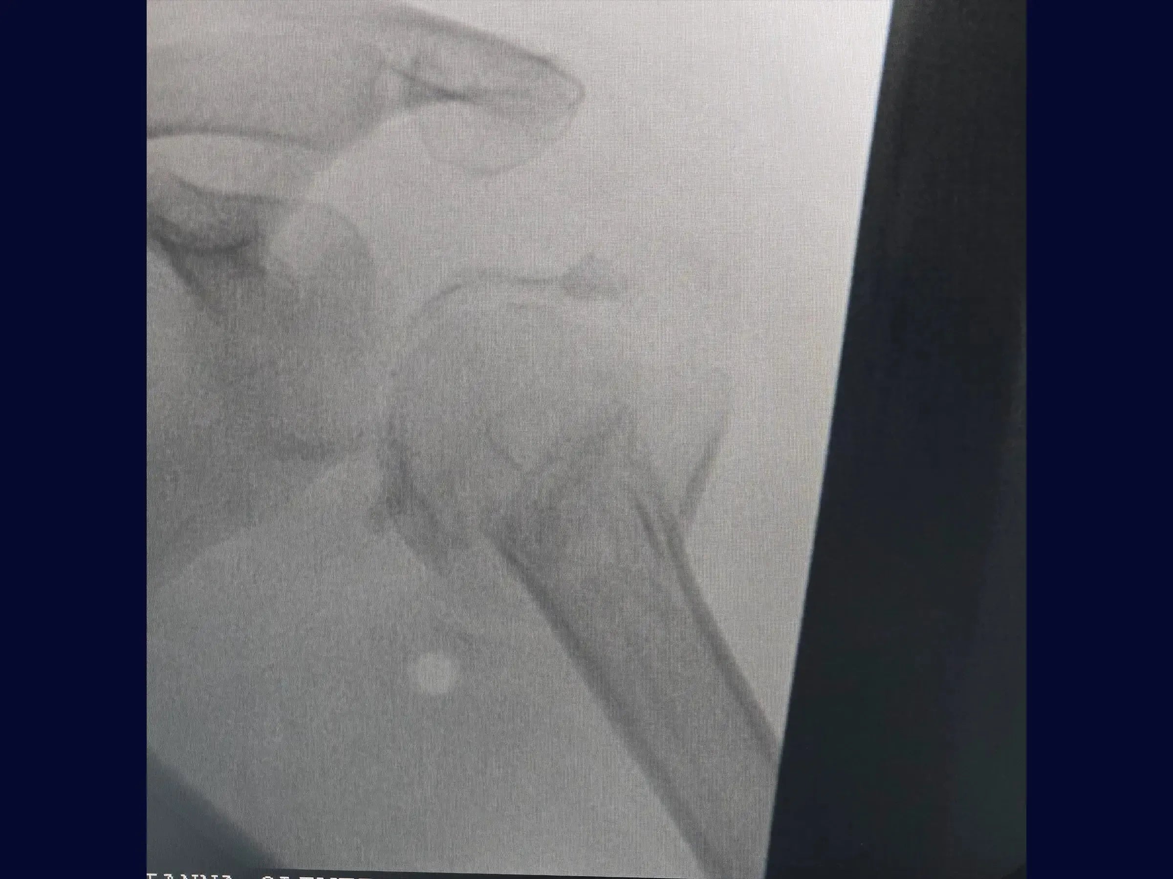 Reconstruction of Complex Four-Part Proximal Humerus Fracture