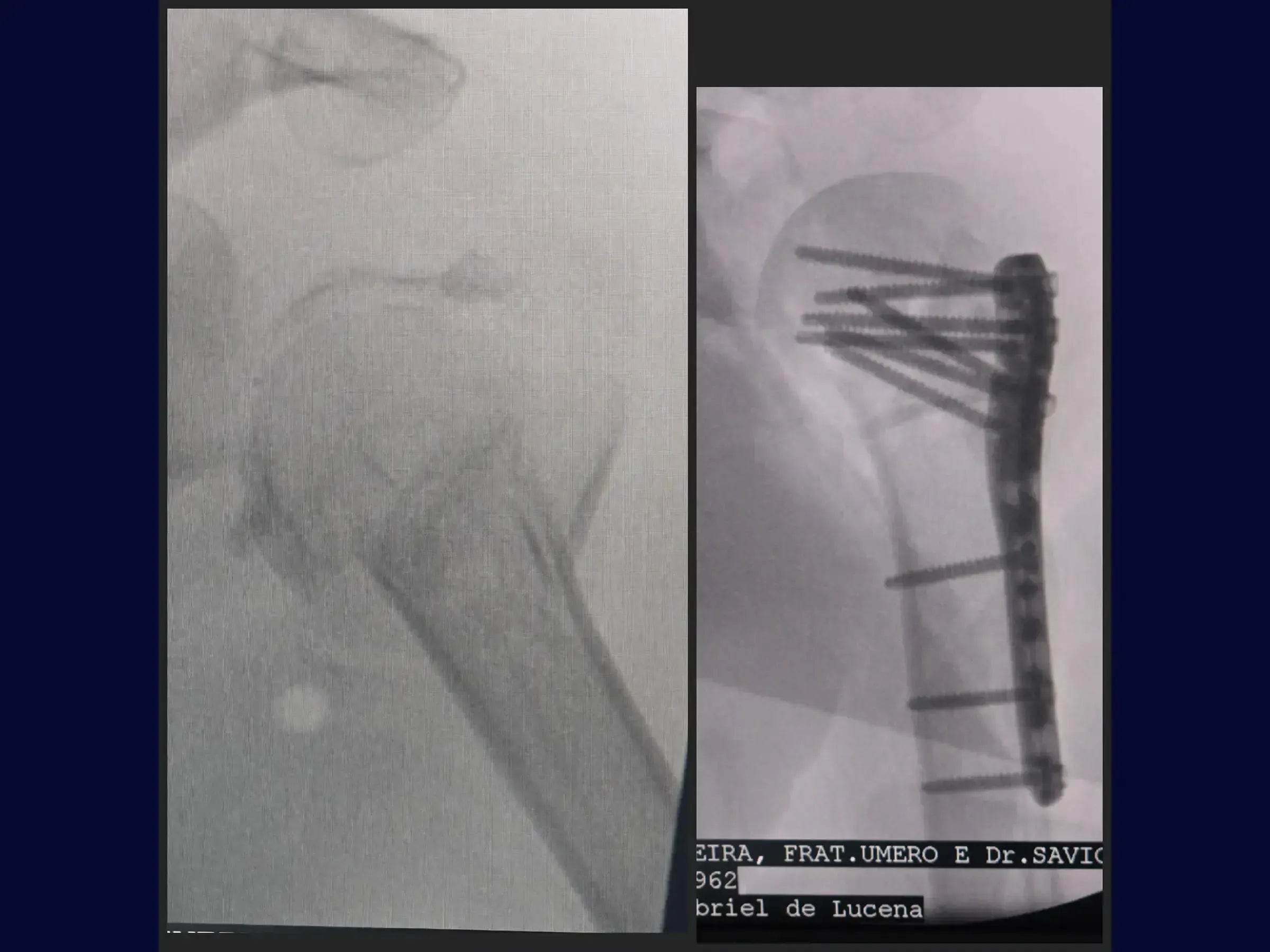 Reconstruction of Complex Four-Part Proximal Humerus Fracture