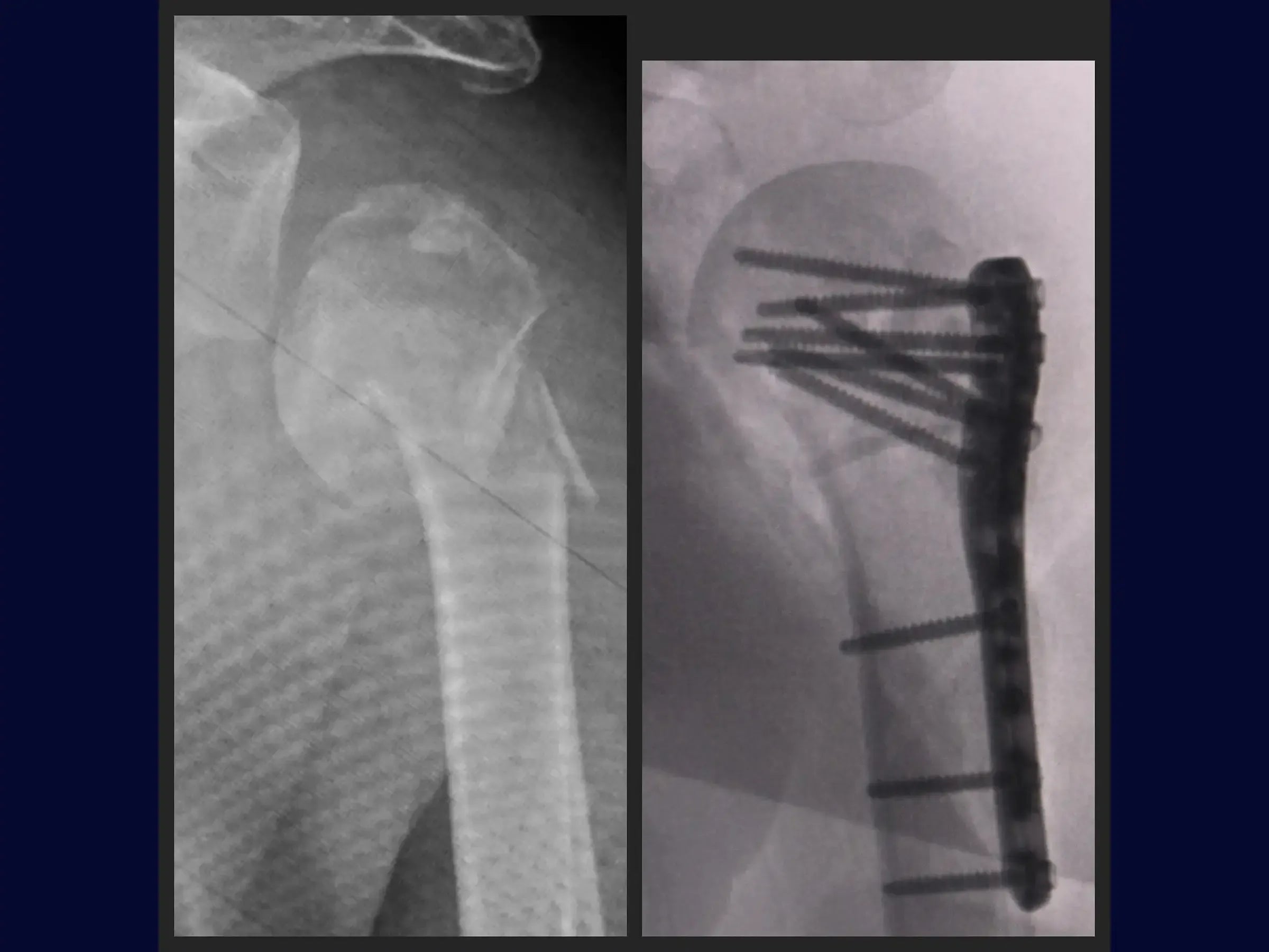 Reconstruction of Complex Four-Part Proximal Humerus Fracture