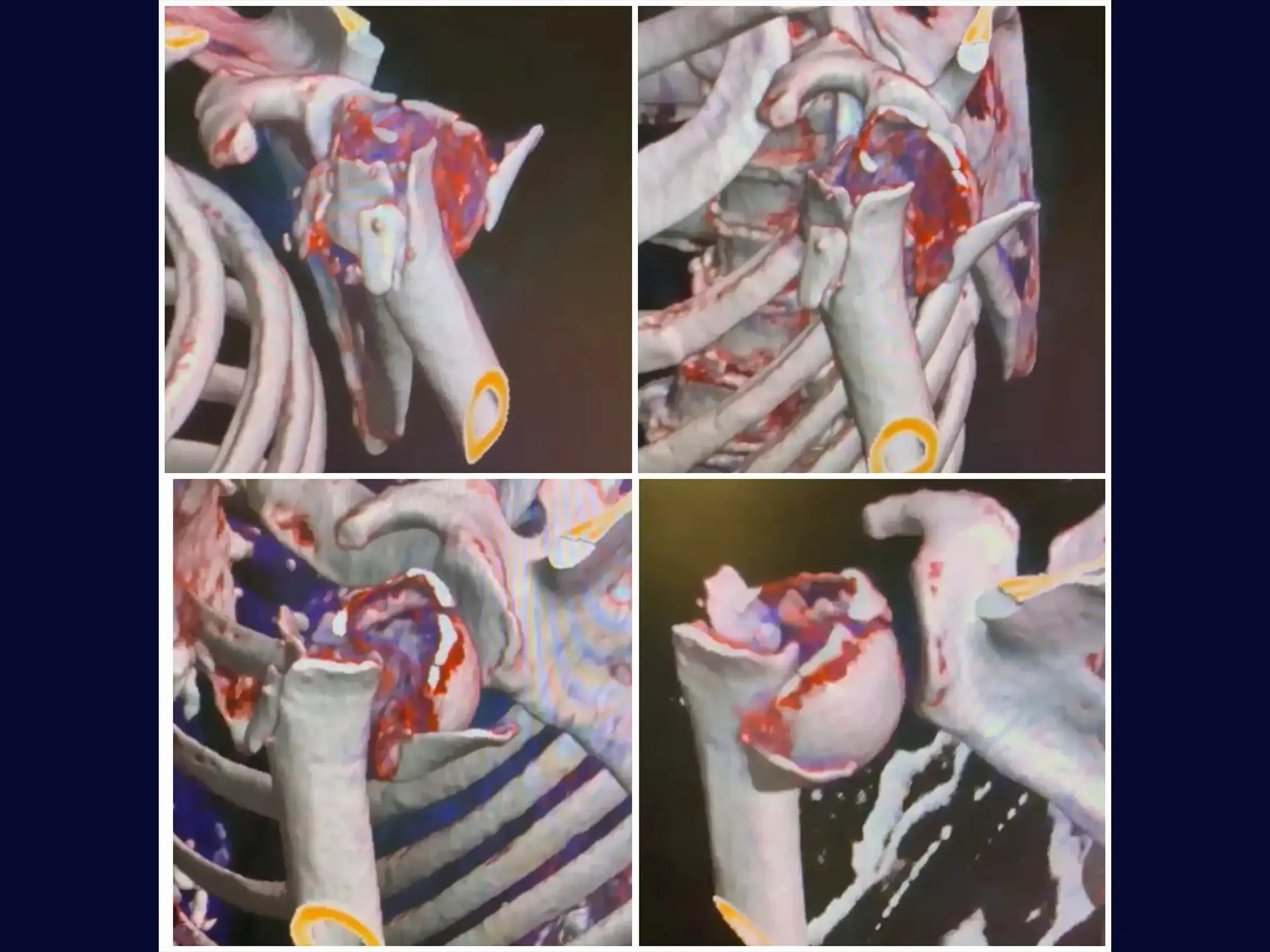 Reconstruction of Complex Four-Part Proximal Humerus Fracture