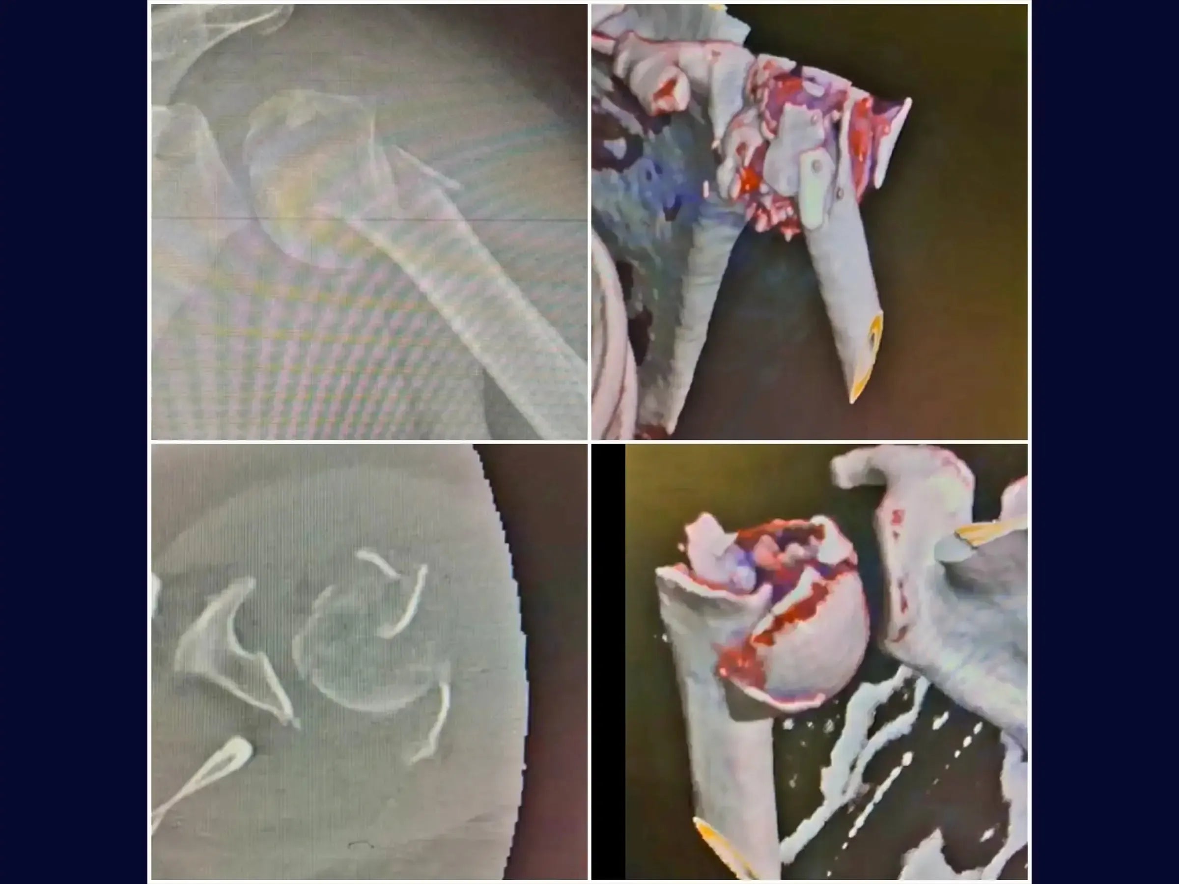 Reconstruction of Complex Four-Part Proximal Humerus Fracture