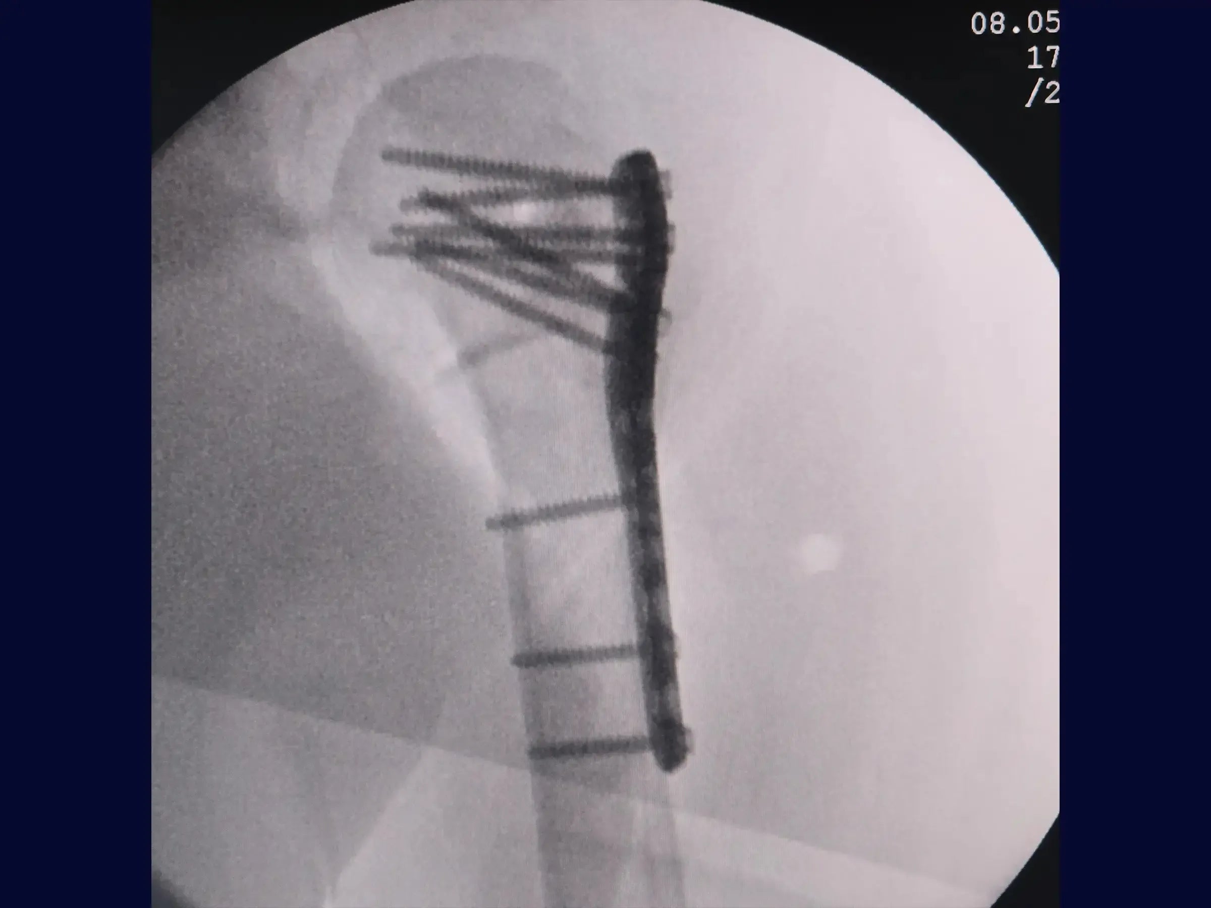 Reconstruction of Complex Four-Part Proximal Humerus Fracture