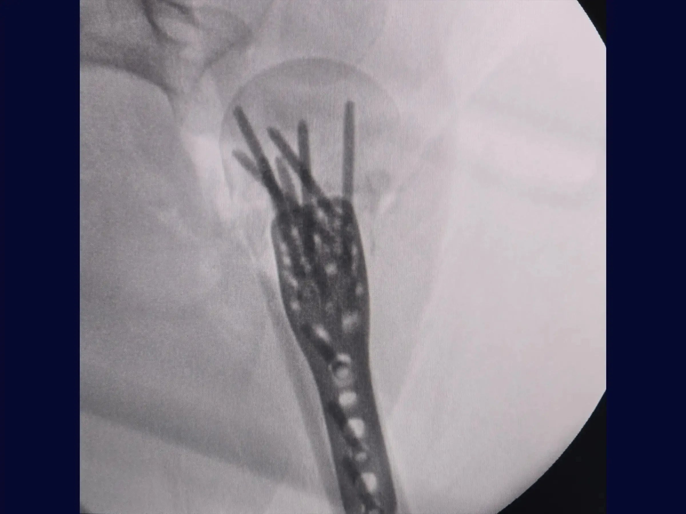 Reconstruction of Complex Four-Part Proximal Humerus Fracture
