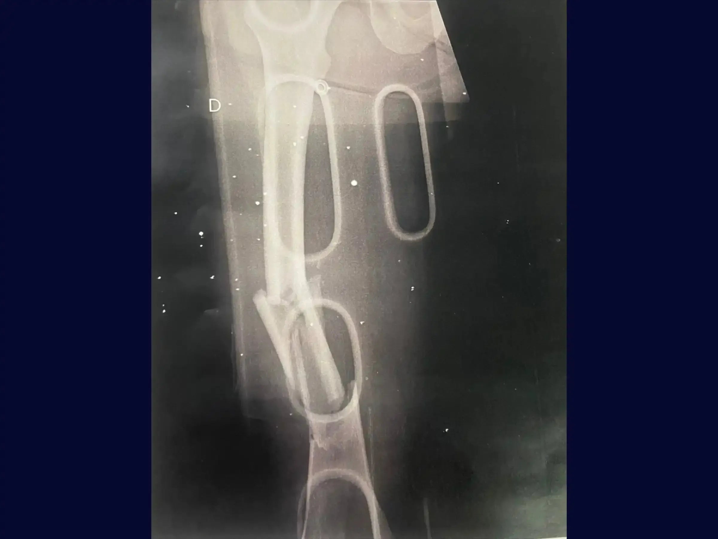 Retrograde Intramedullary Nailing for Femoral Diaphyseal Fracture