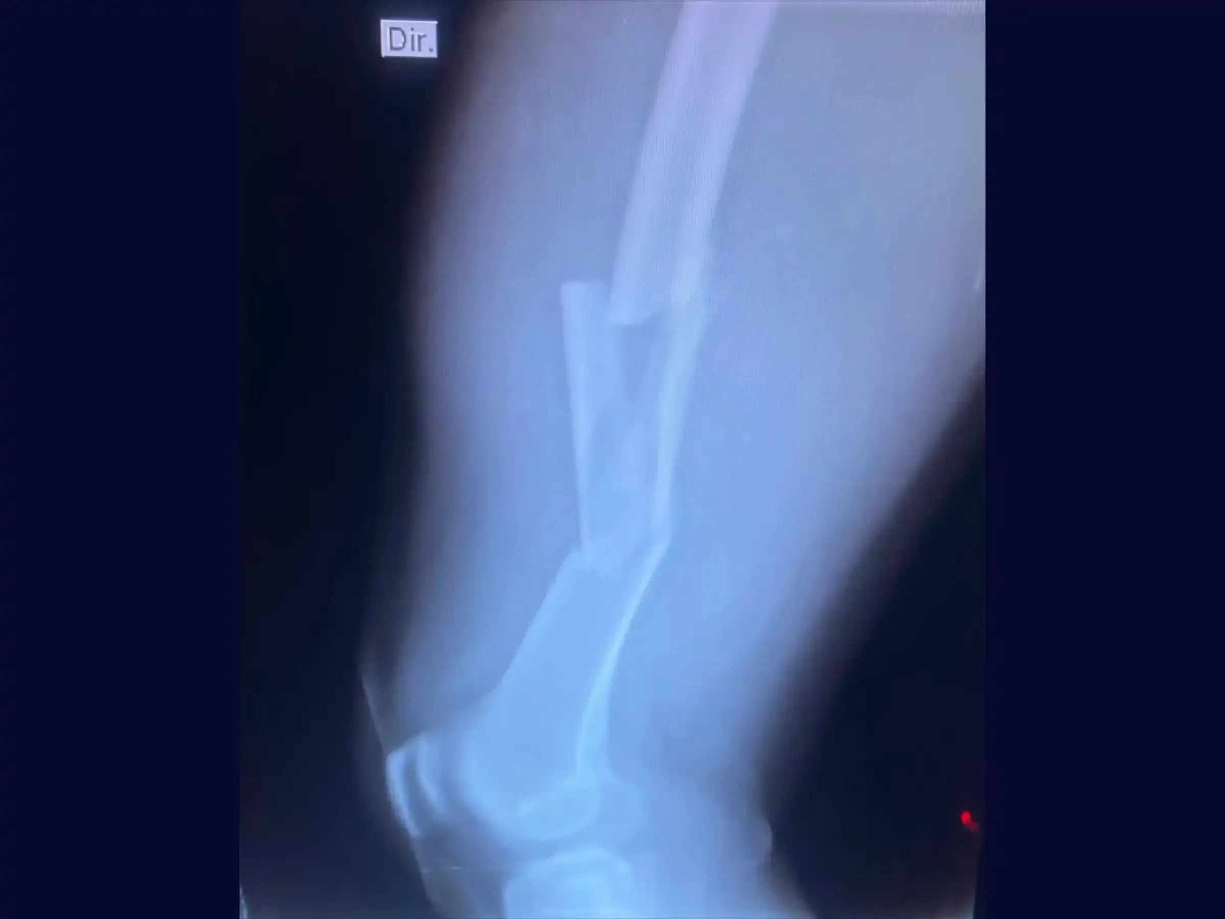 Retrograde Intramedullary Nailing for Femoral Diaphyseal Fracture