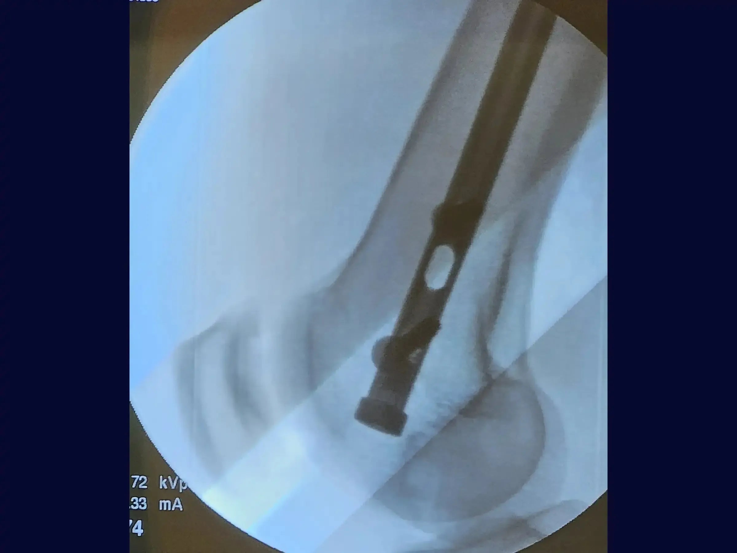 Retrograde Intramedullary Nailing for Femoral Diaphyseal Fracture