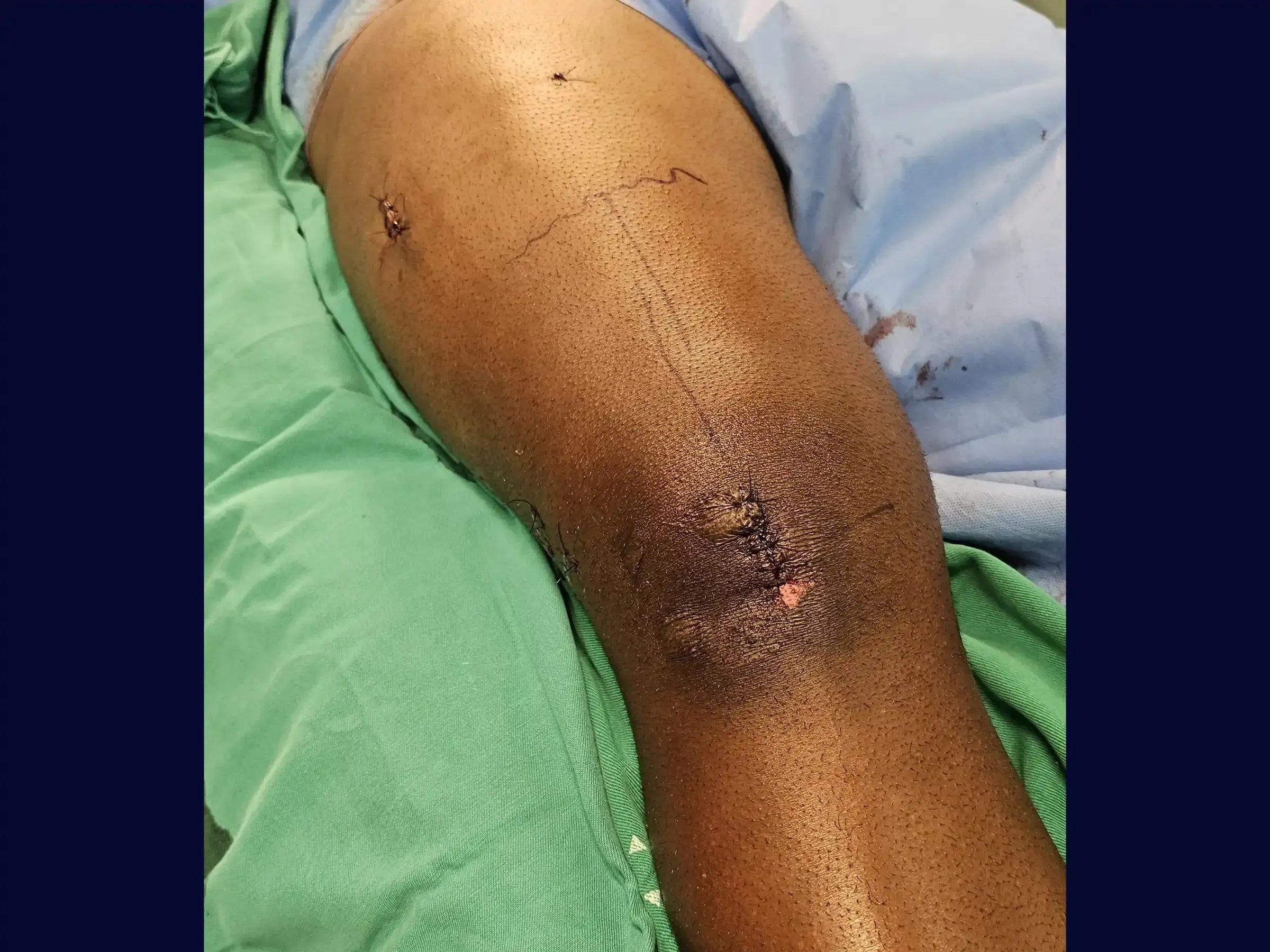 Retrograde Intramedullary Nailing for Femoral Diaphyseal Fracture