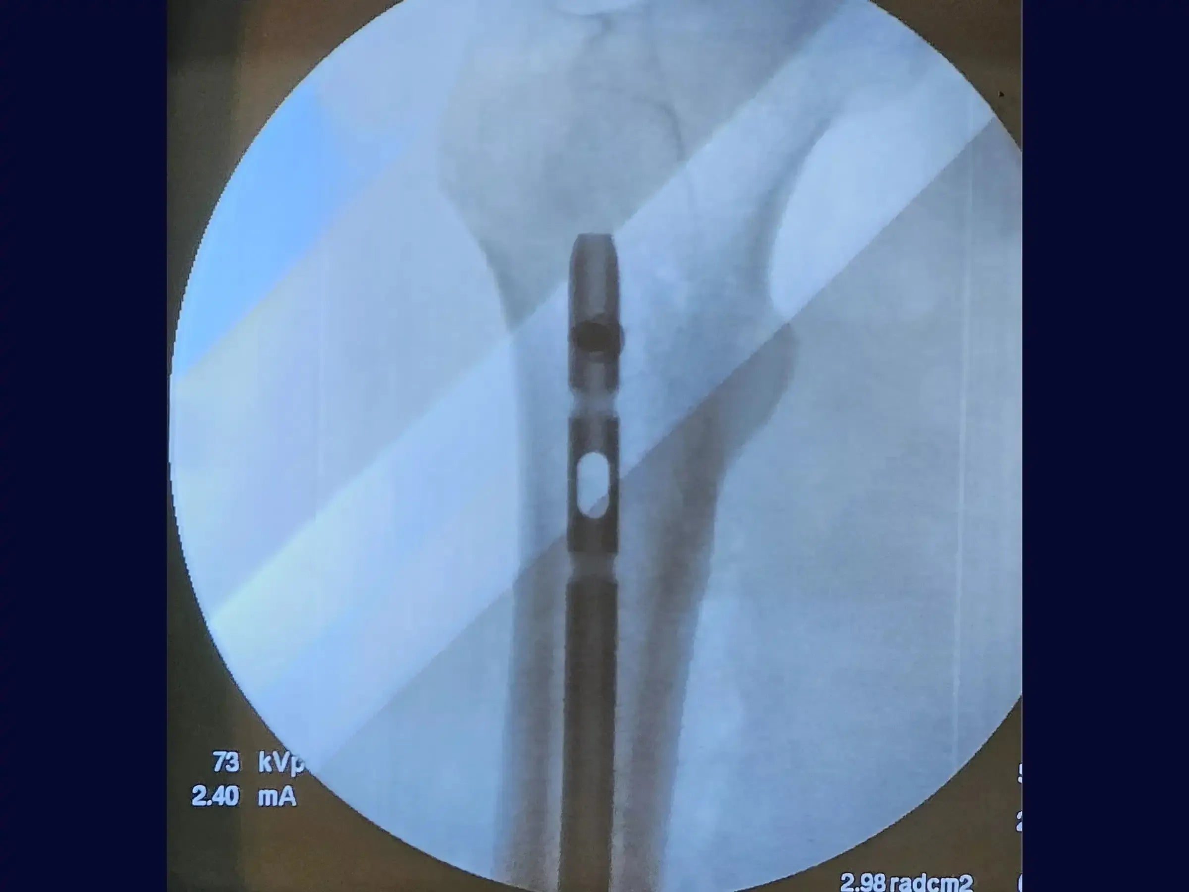 Retrograde Intramedullary Nailing for Femoral Diaphyseal Fracture