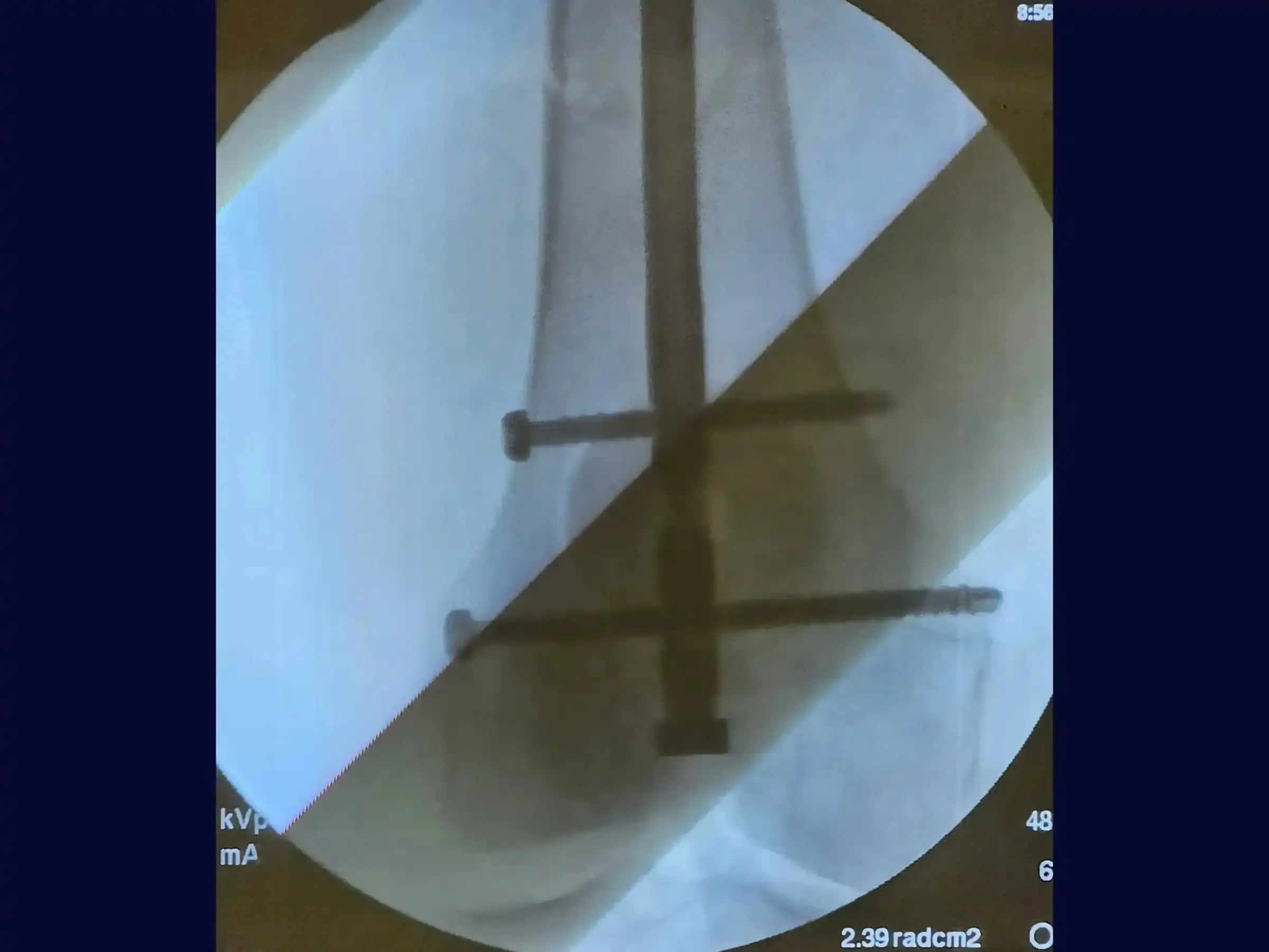 Retrograde Intramedullary Nailing for Femoral Diaphyseal Fracture