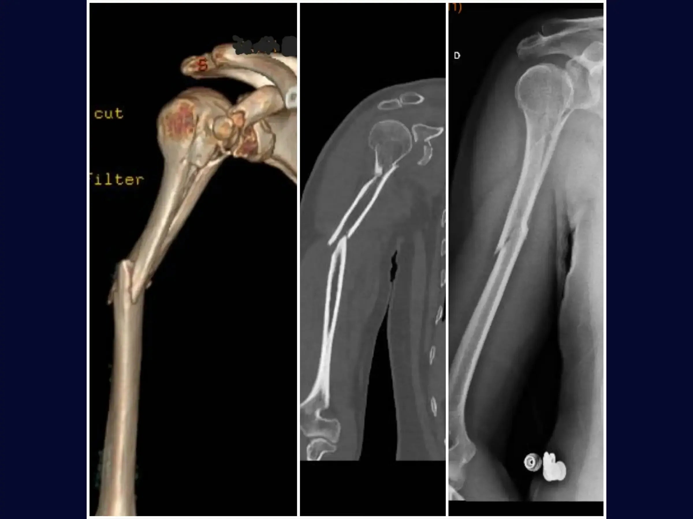 Segmental Humeral Fracture Associated with Glenoid and Coracoid Process Fractures