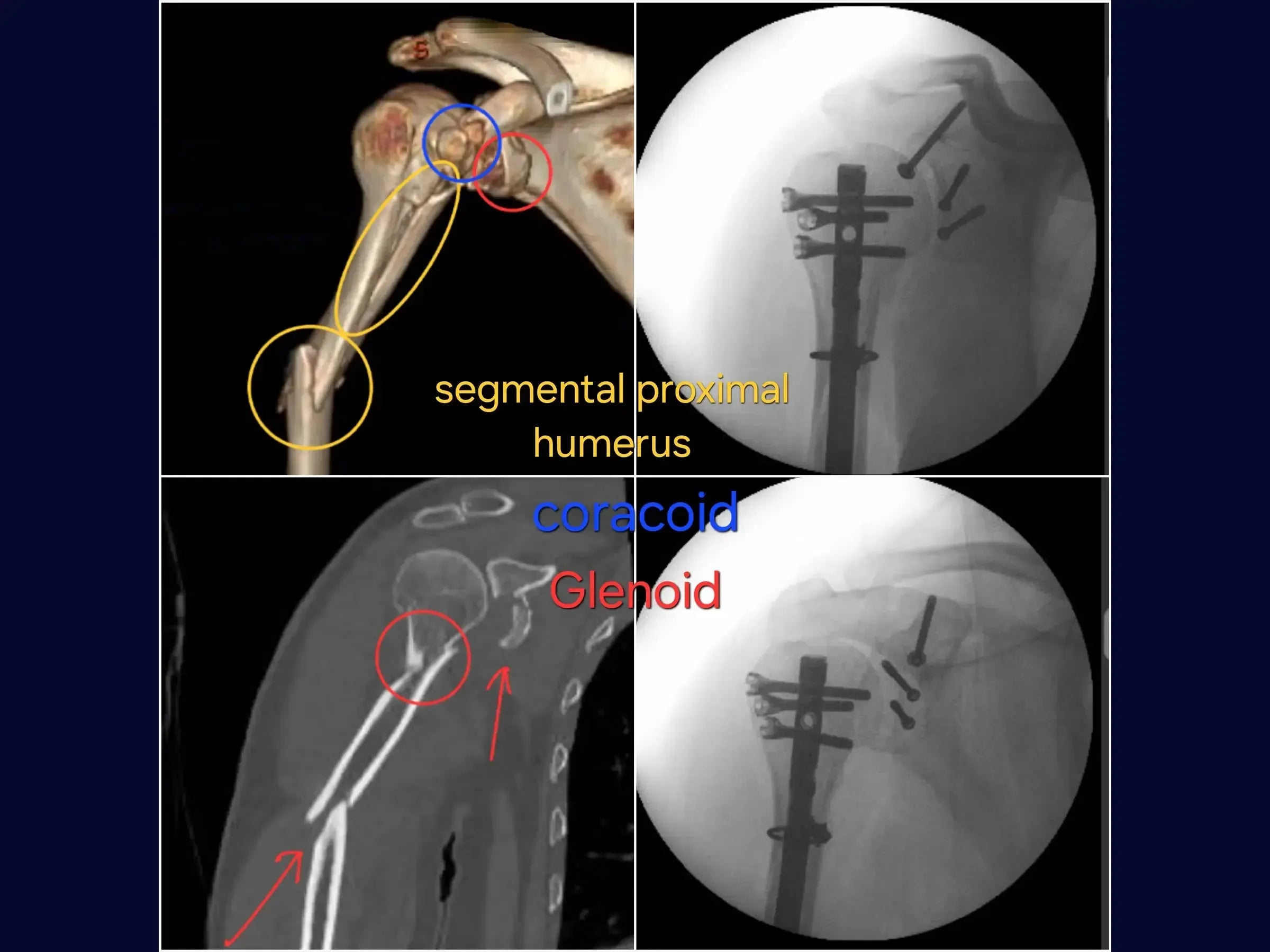 Segmental Humeral Fracture Associated with Glenoid and Coracoid Process Fractures
